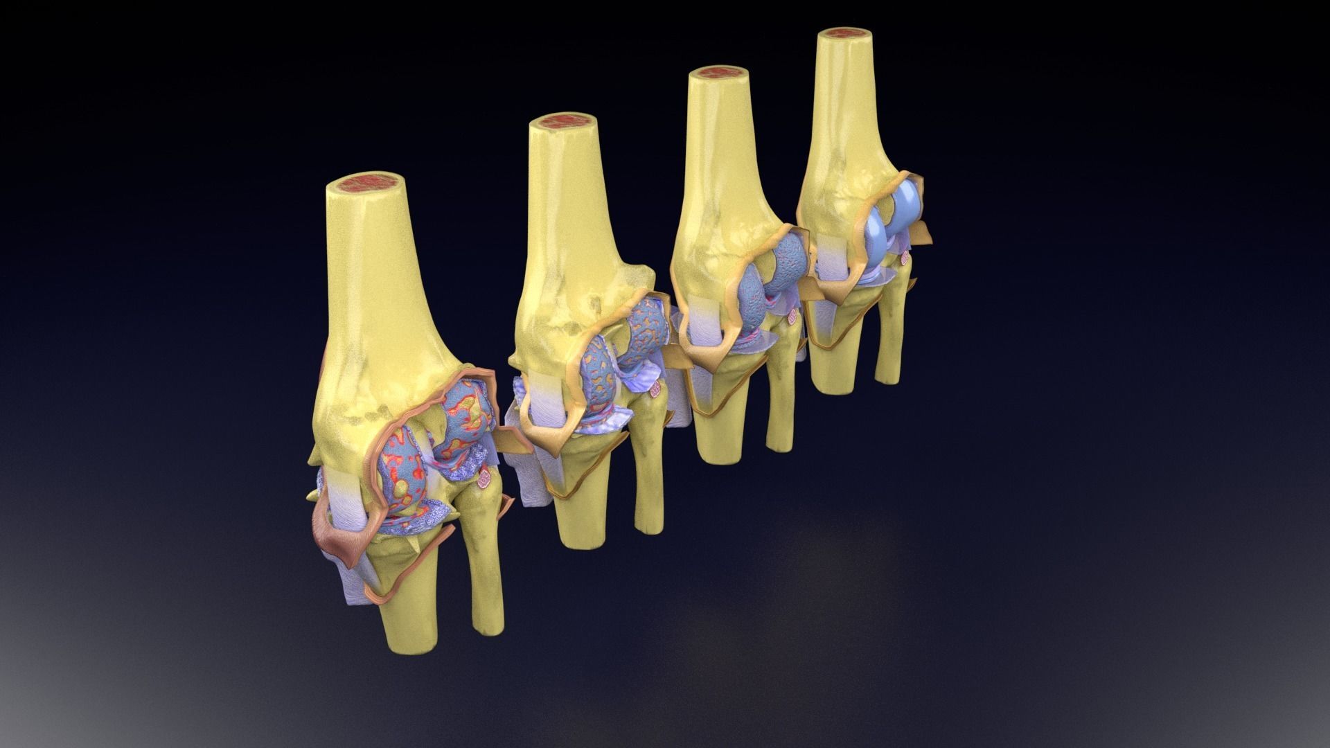 Osteoarthritis stages 3D model_90