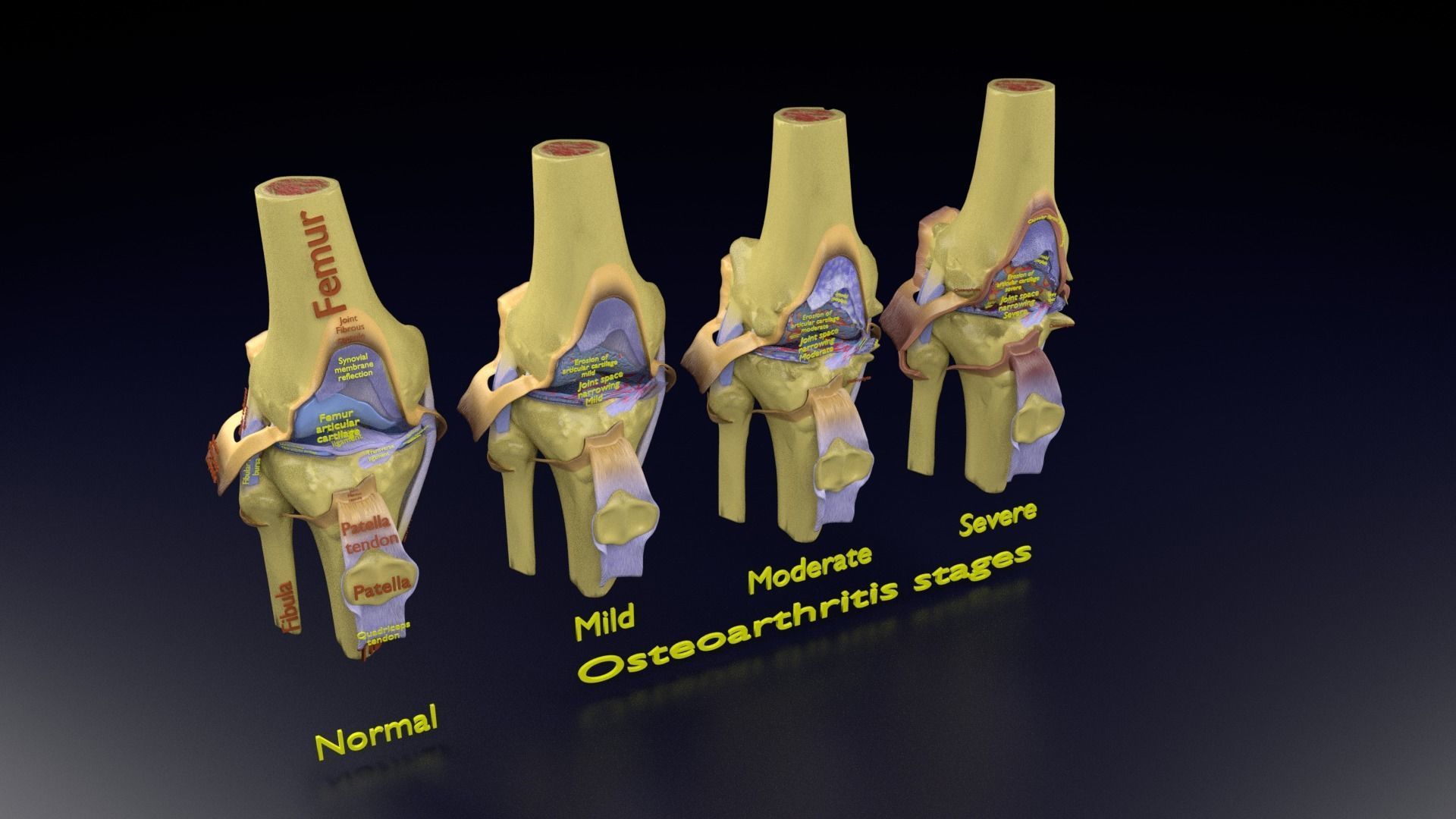Osteoarthritis stages 3D model_112