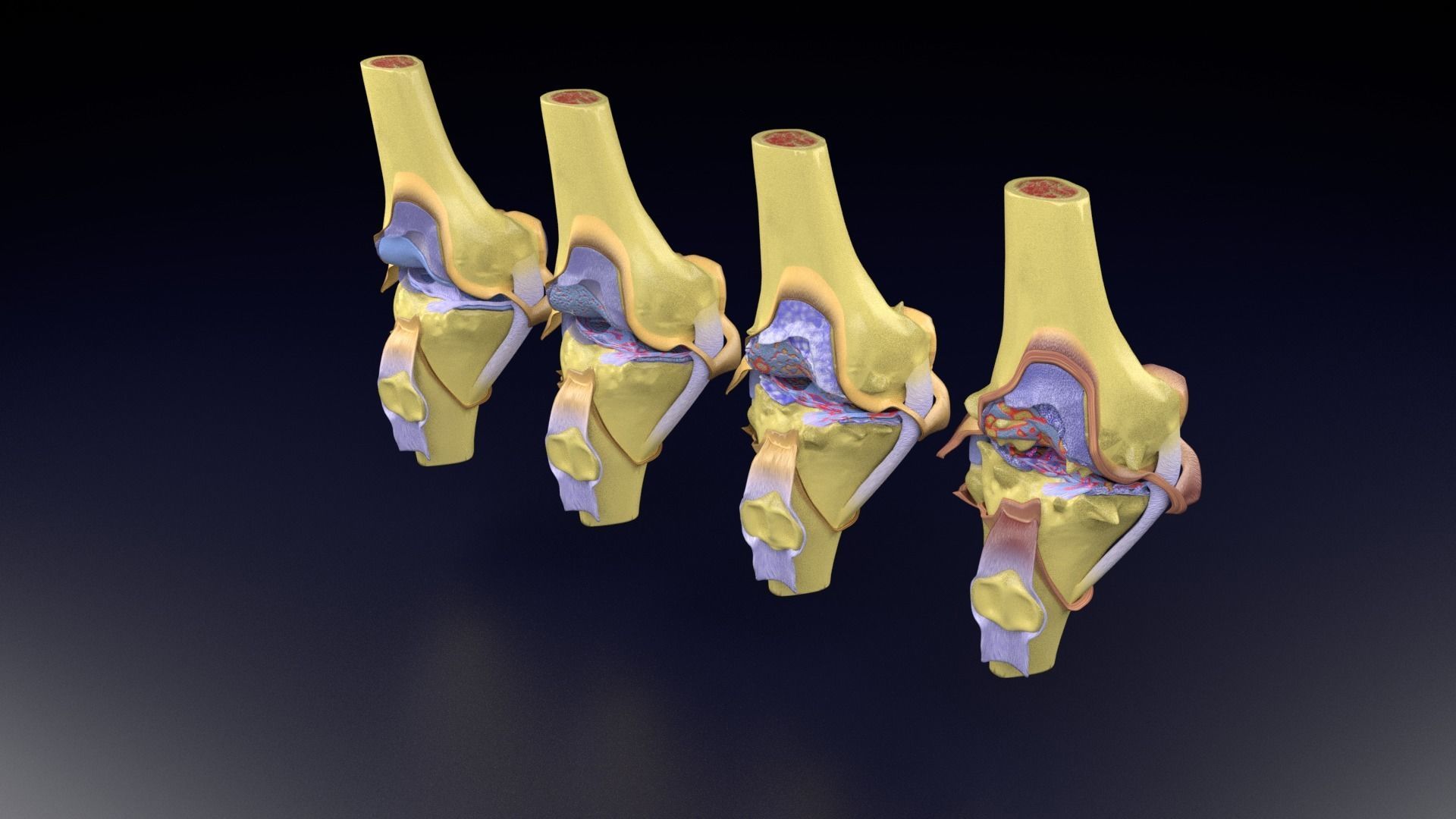 Osteoarthritis stages 3D model_84