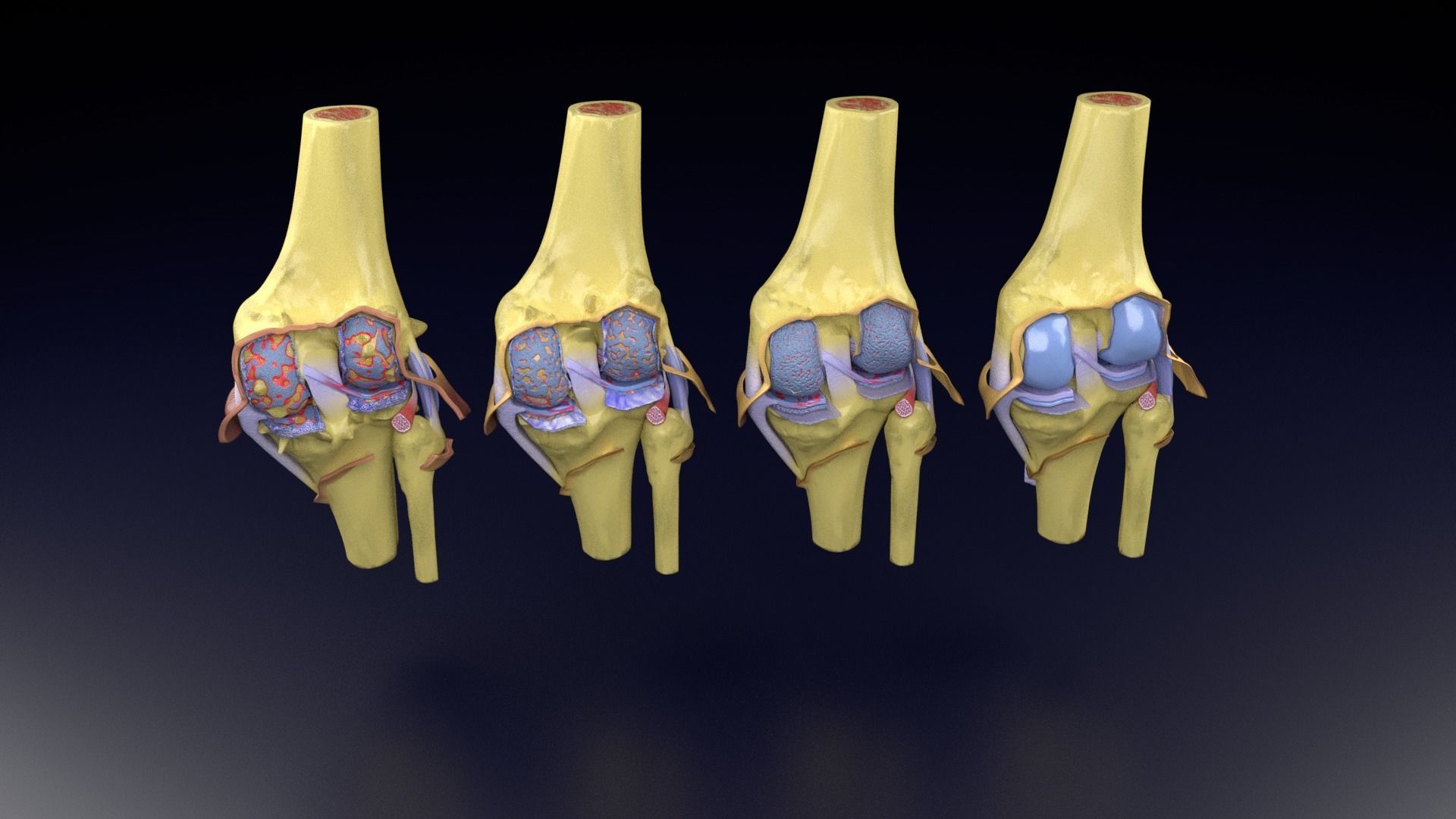 Osteoarthritis stages 3D model_58
