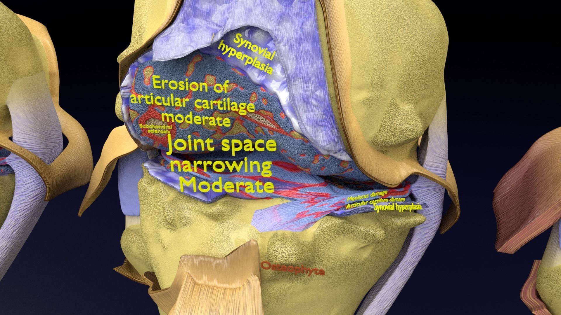 Osteoarthritis stages 3D model_7