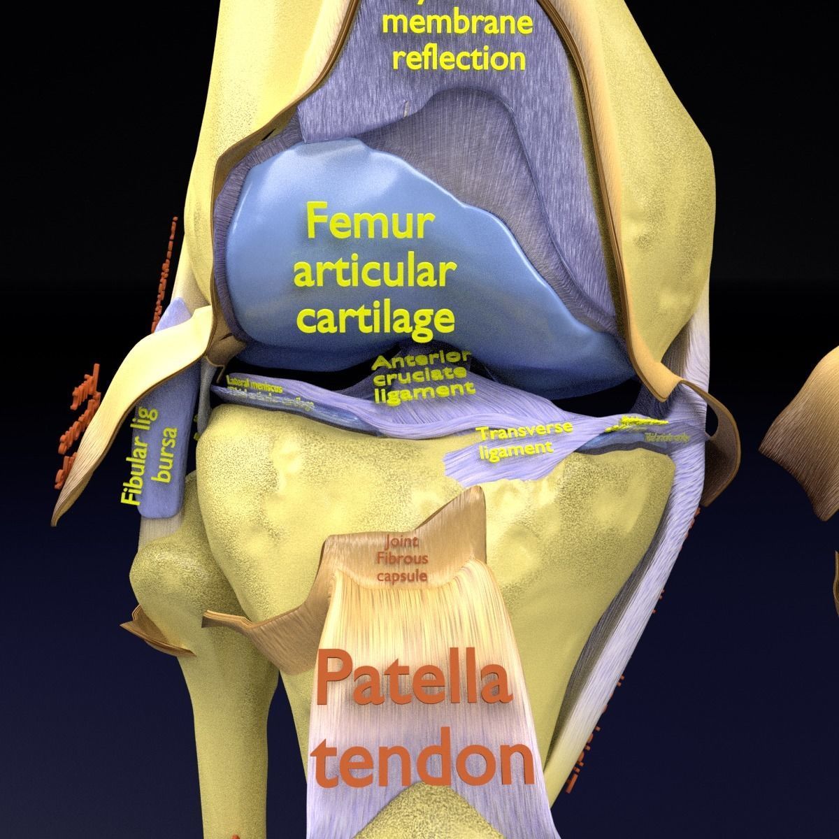 Osteoarthritis stages 3D model_25