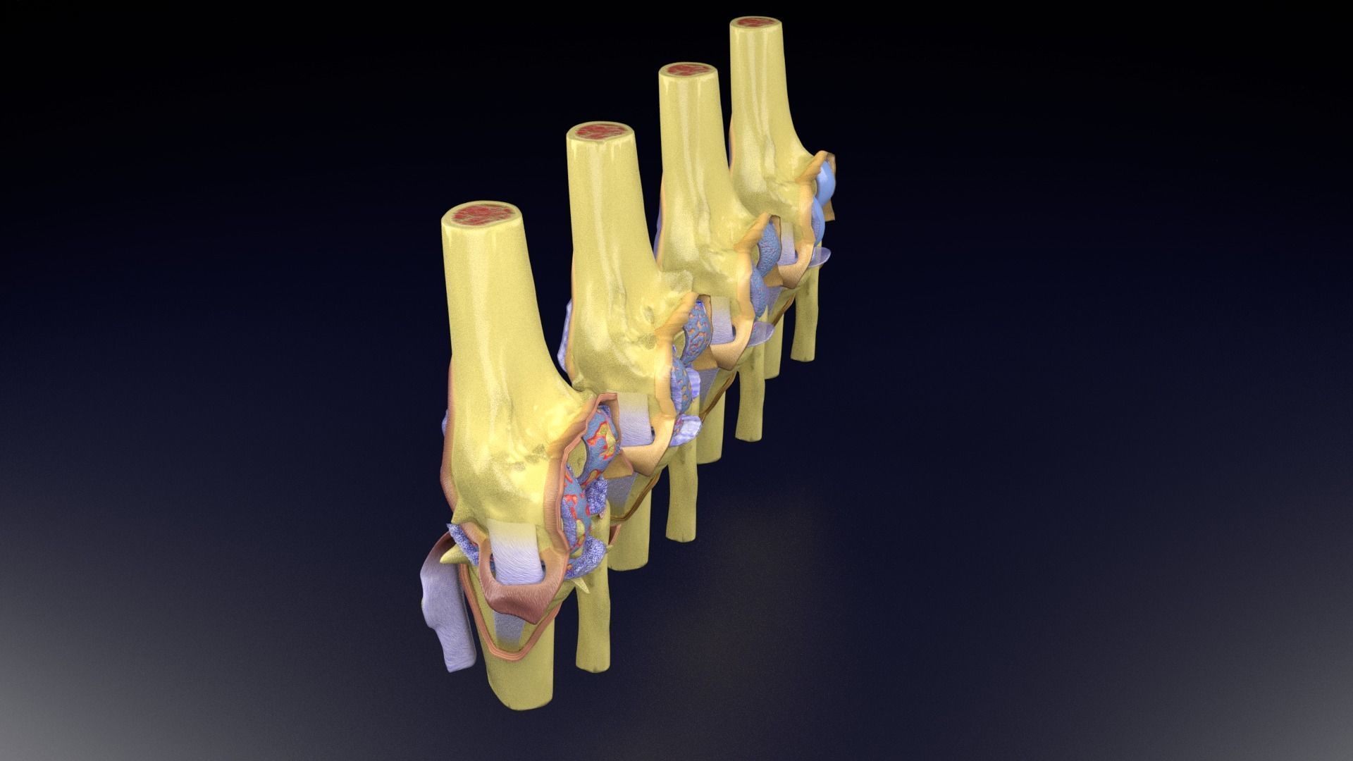 Osteoarthritis stages 3D model_69