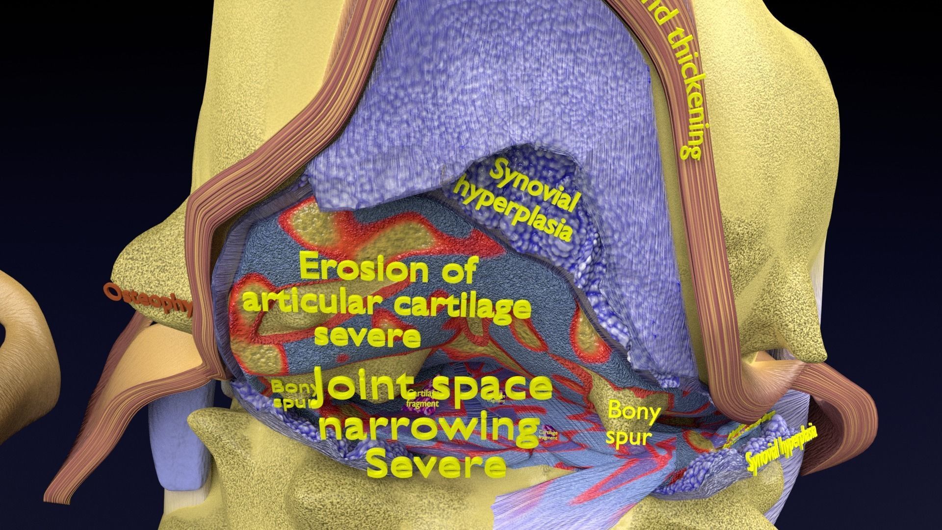 Osteoarthritis stages 3D model_16