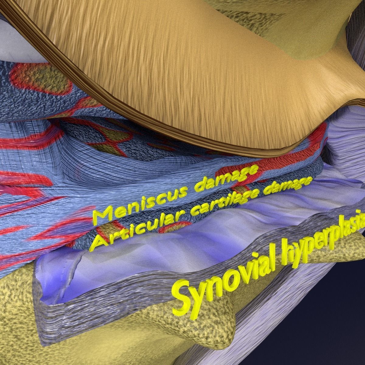 Osteoarthritis stages 3D model_11