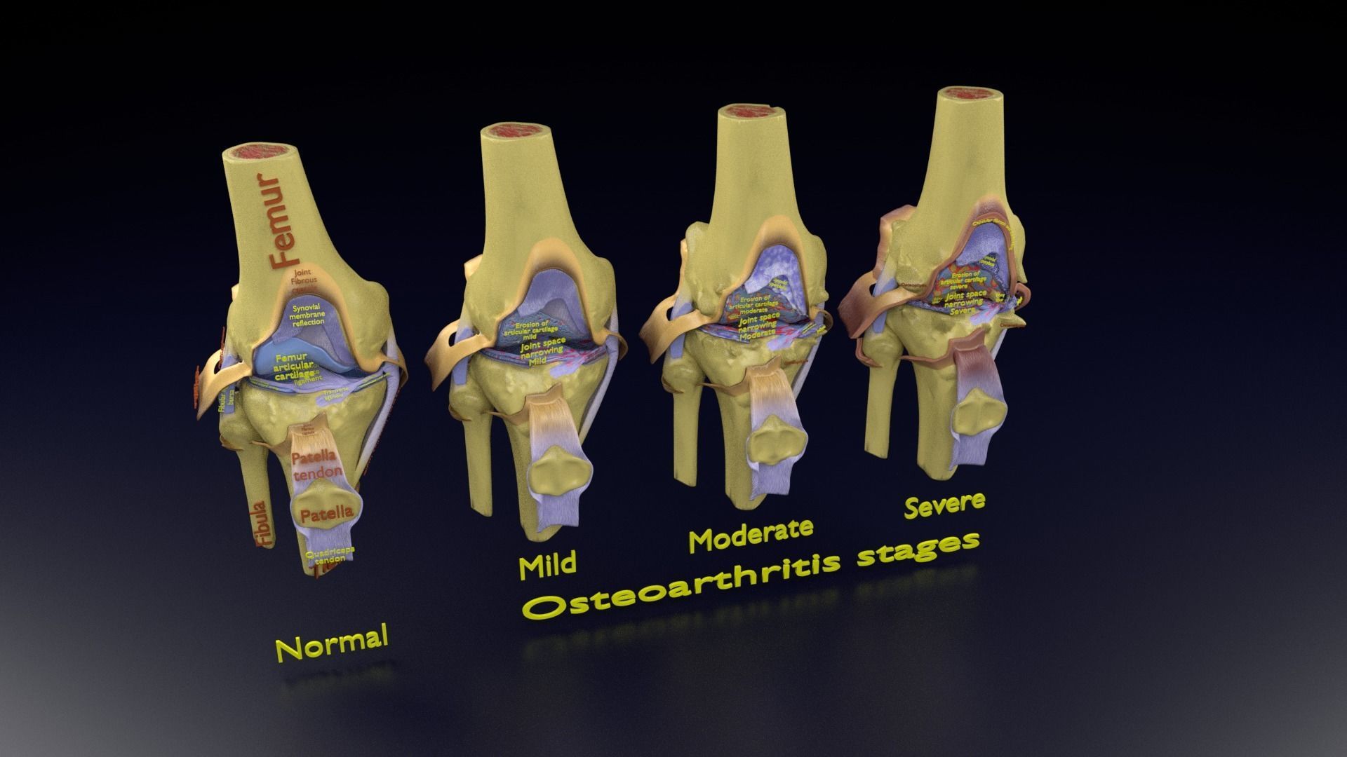 Osteoarthritis stages 3D model_113