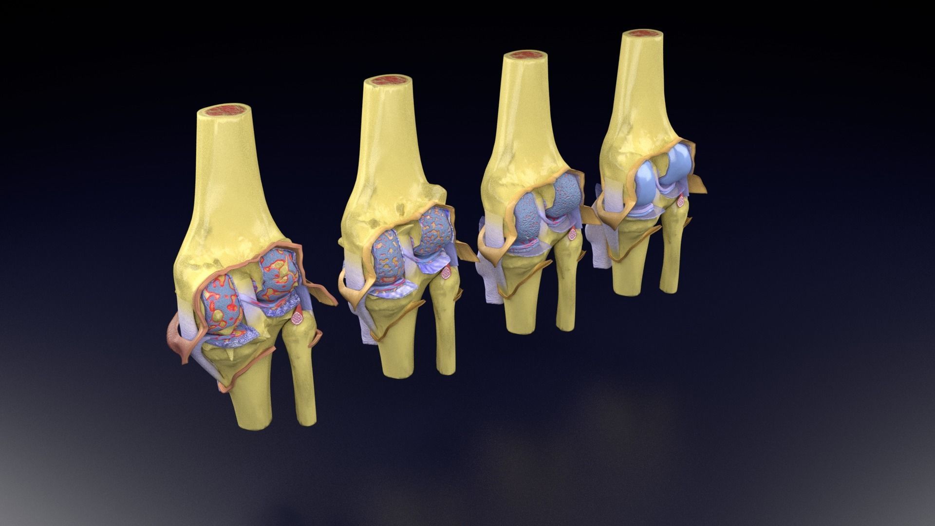 Osteoarthritis stages 3D model_62