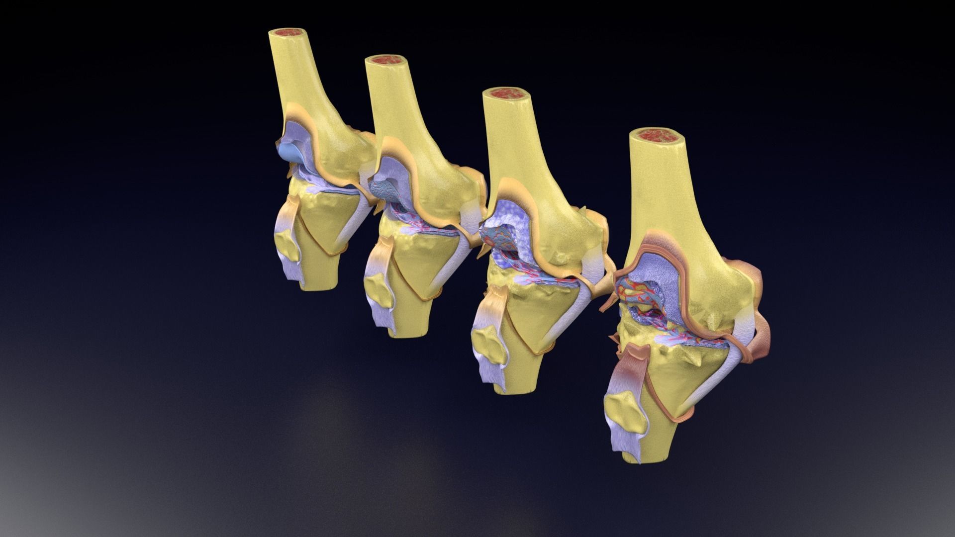Osteoarthritis stages 3D model_83