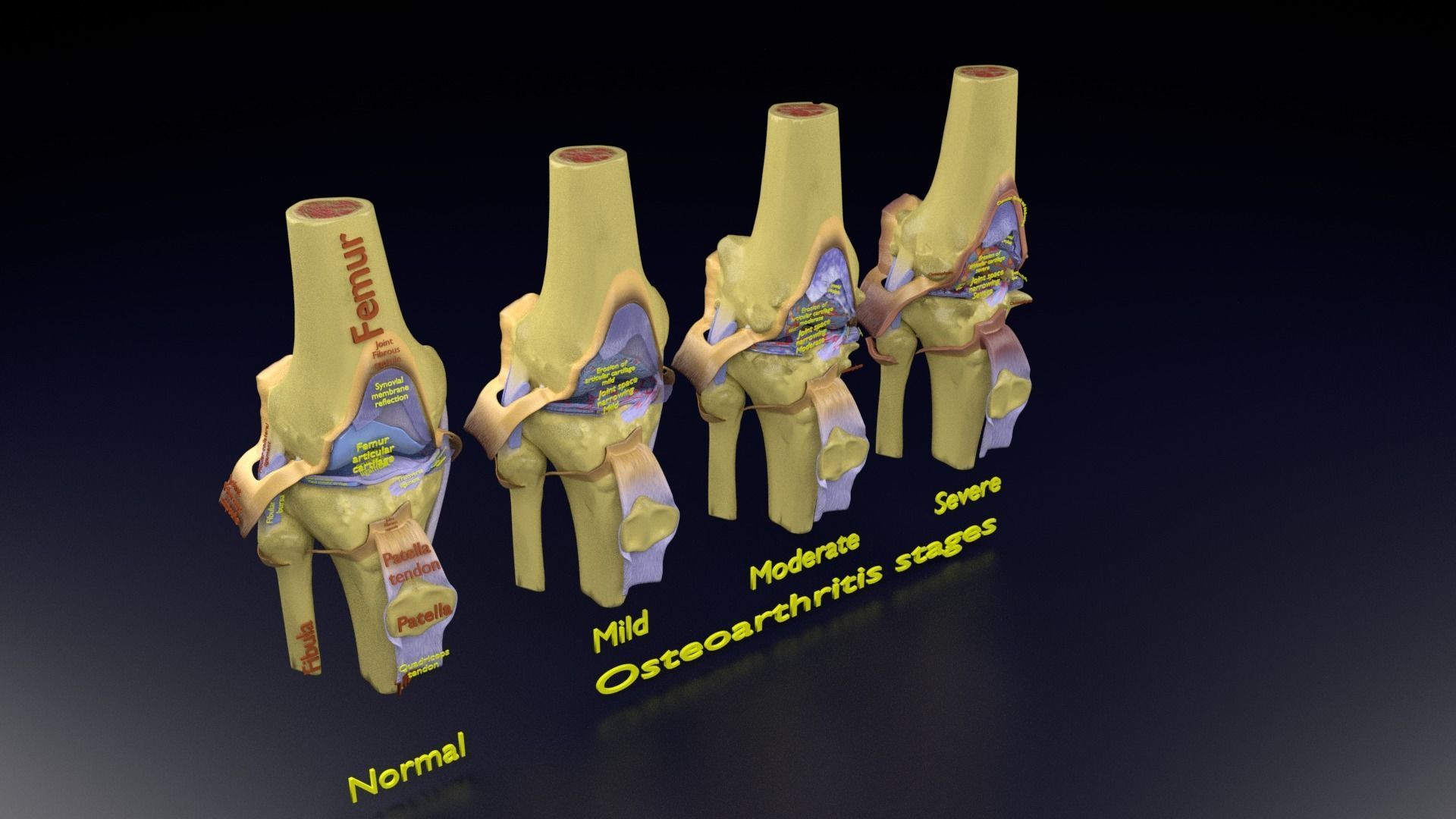 Osteoarthritis stages 3D model_118