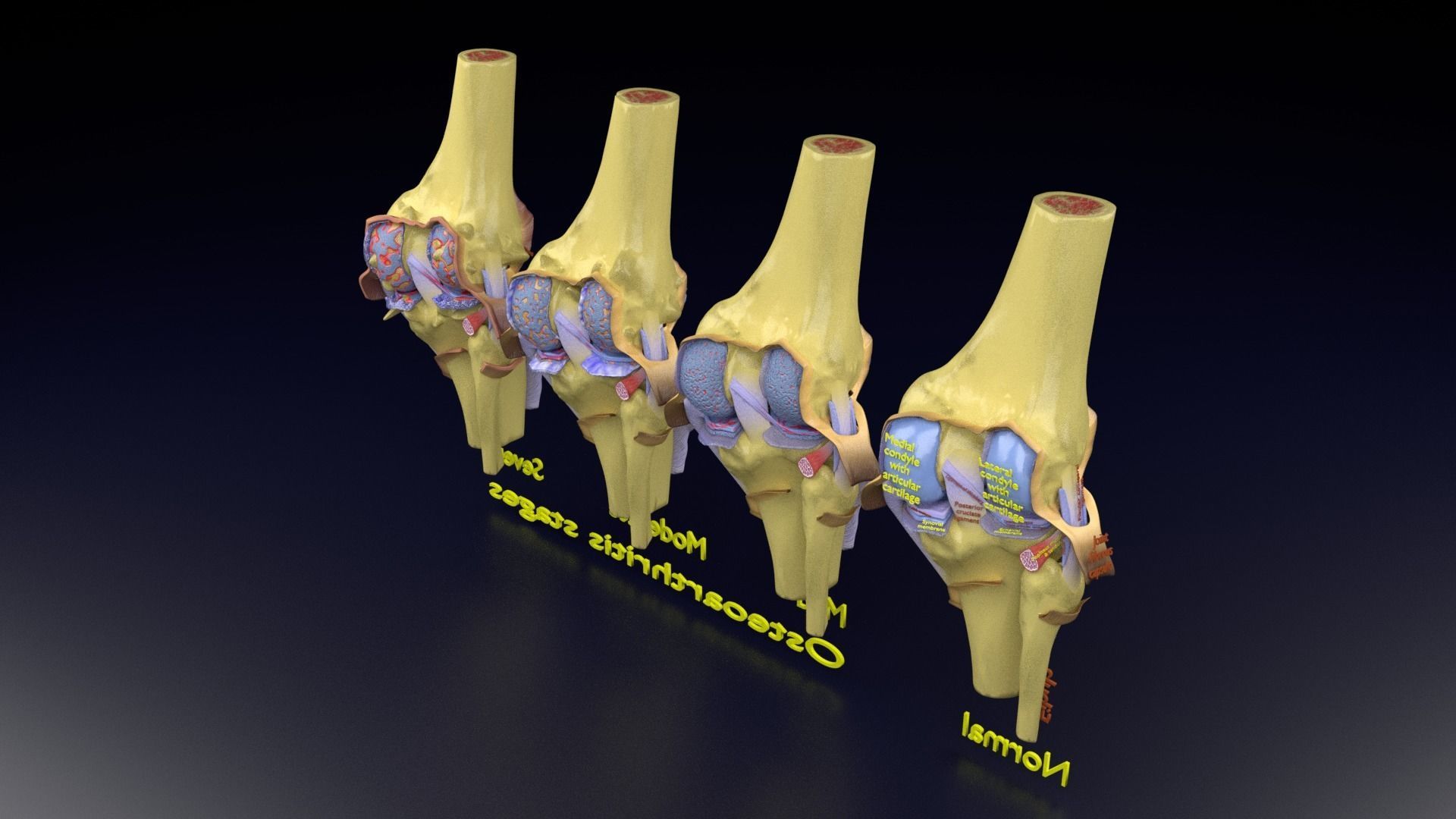 Osteoarthritis stages 3D model_133