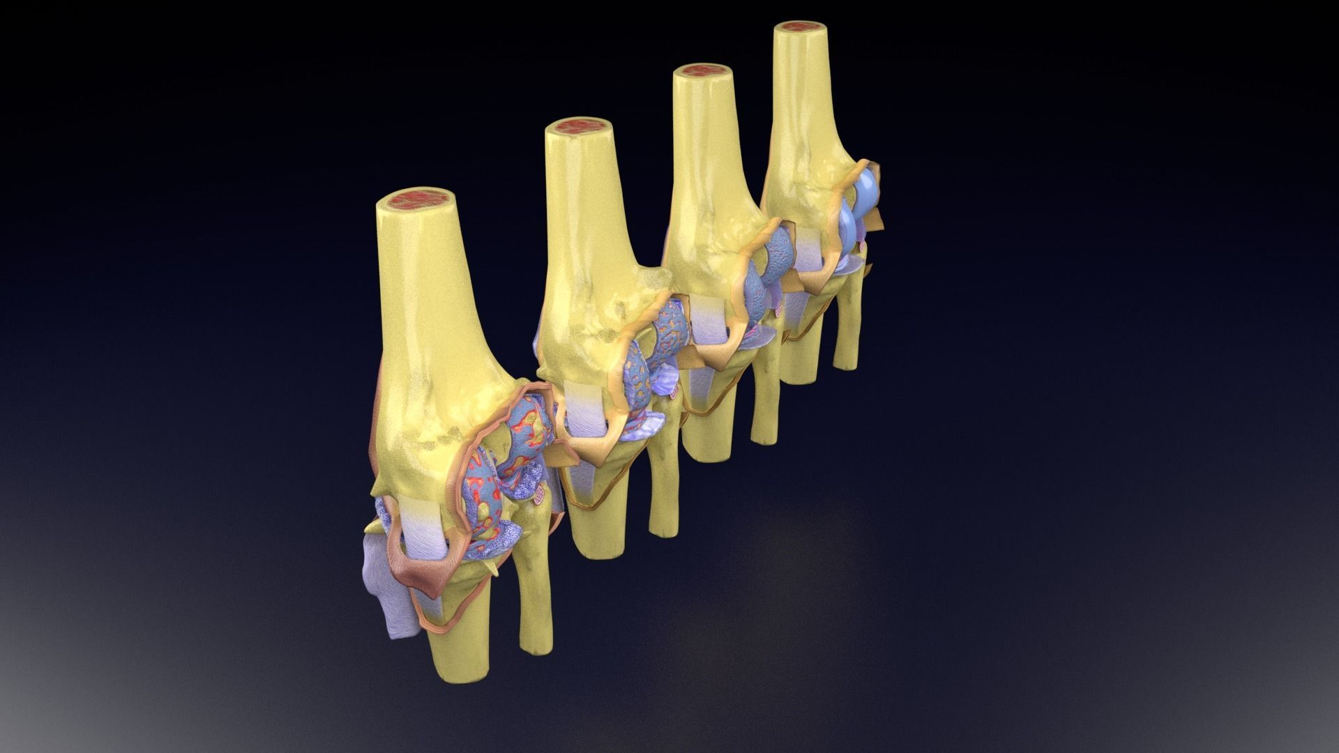 Osteoarthritis stages 3D model_67