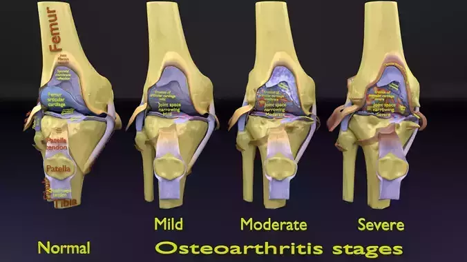 Osteoarthritis stages 3D model