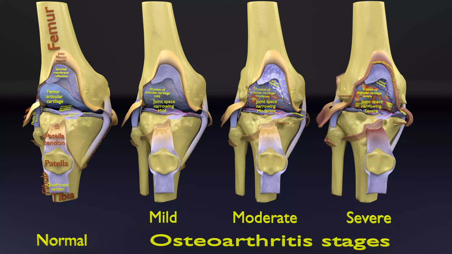 Osteoarthritis stages 3D model_0