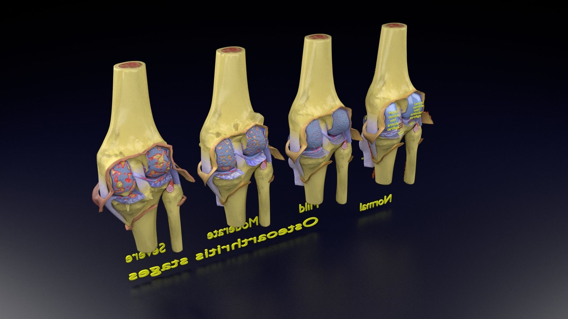 Osteoarthritis stages 3D model_139