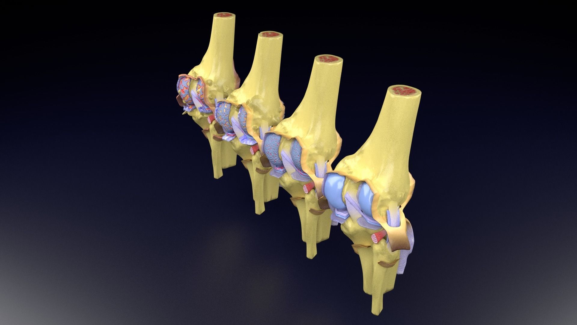 Osteoarthritis stages 3D model_47