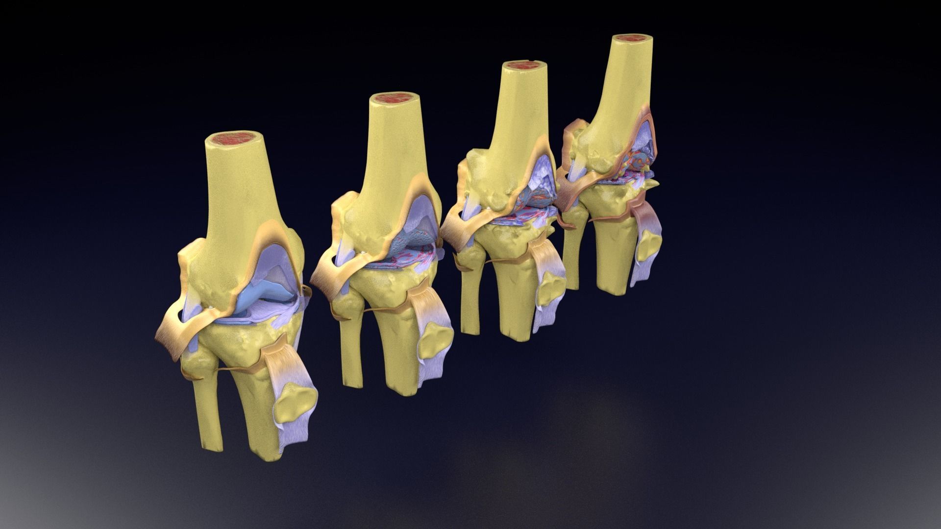 Osteoarthritis stages 3D model_106