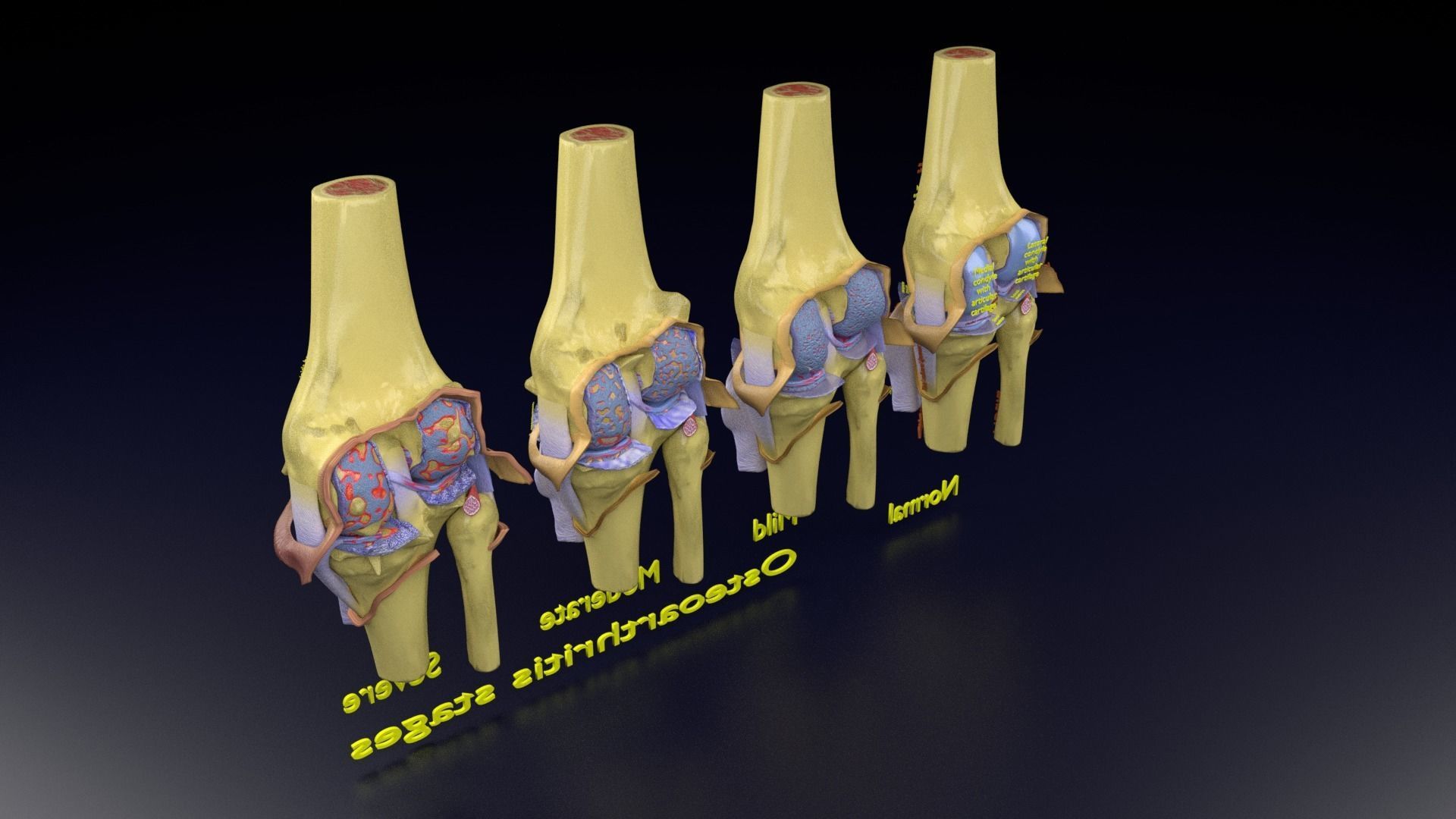 Osteoarthritis stages 3D model_145