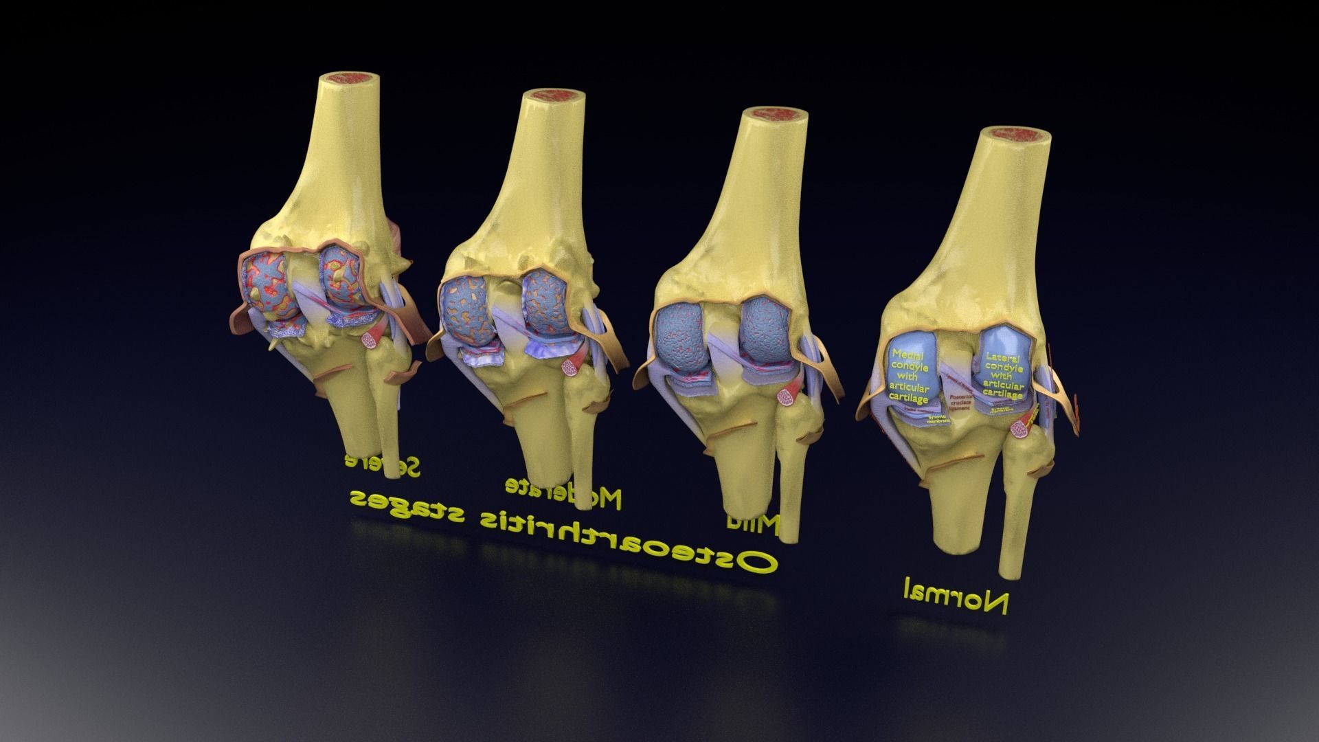 Osteoarthritis stages 3D model_148