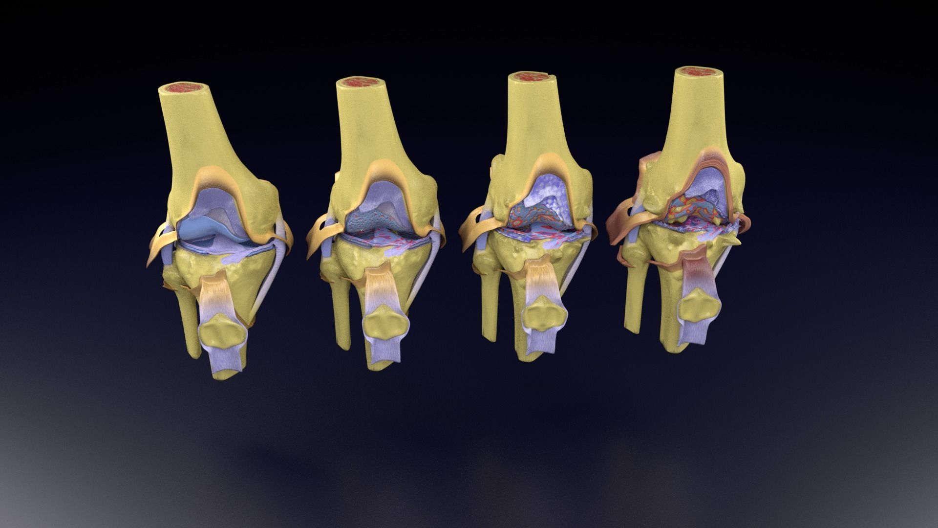 Osteoarthritis stages 3D model_95