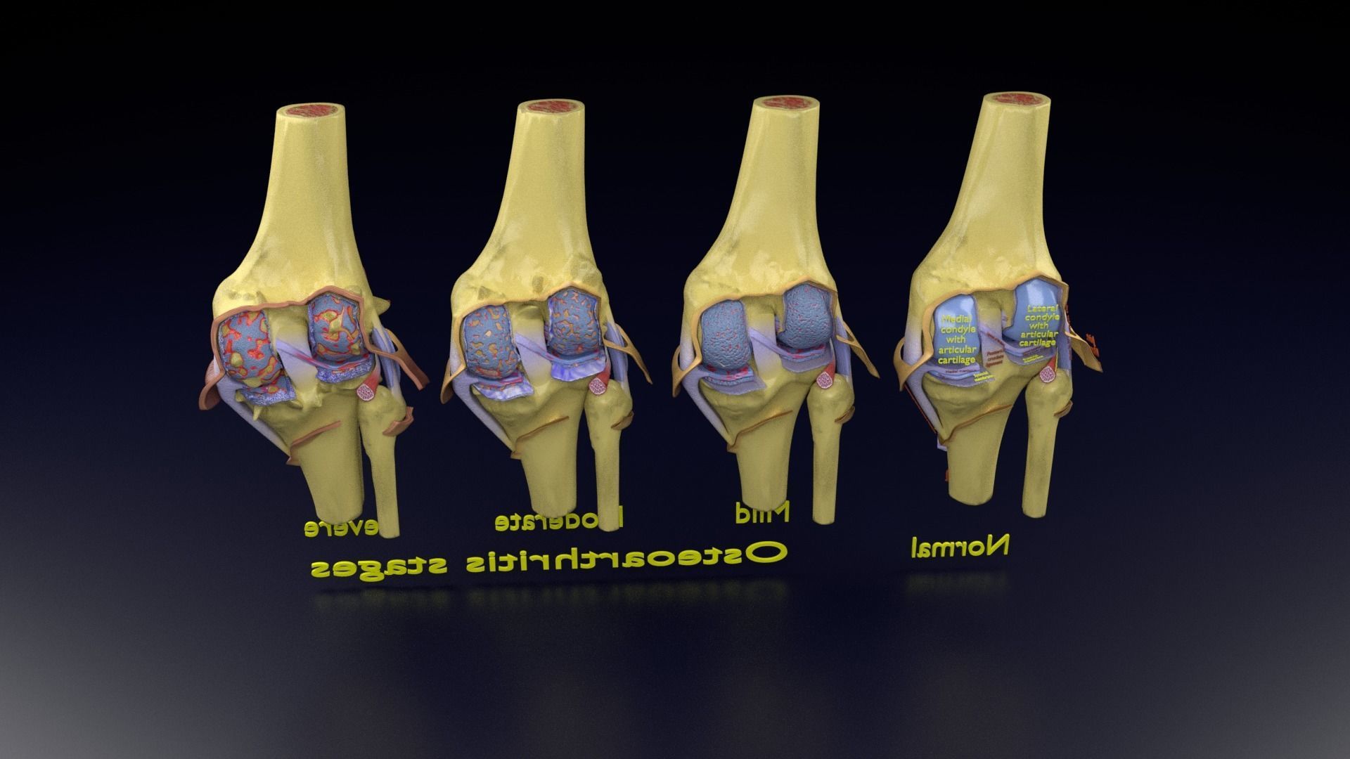 Osteoarthritis stages 3D model_136