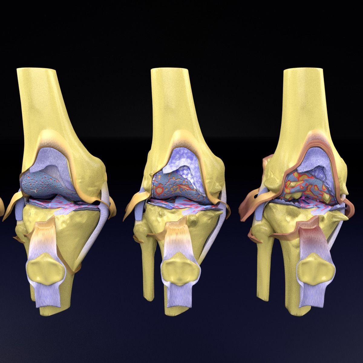 Osteoarthritis stages 3D model_23
