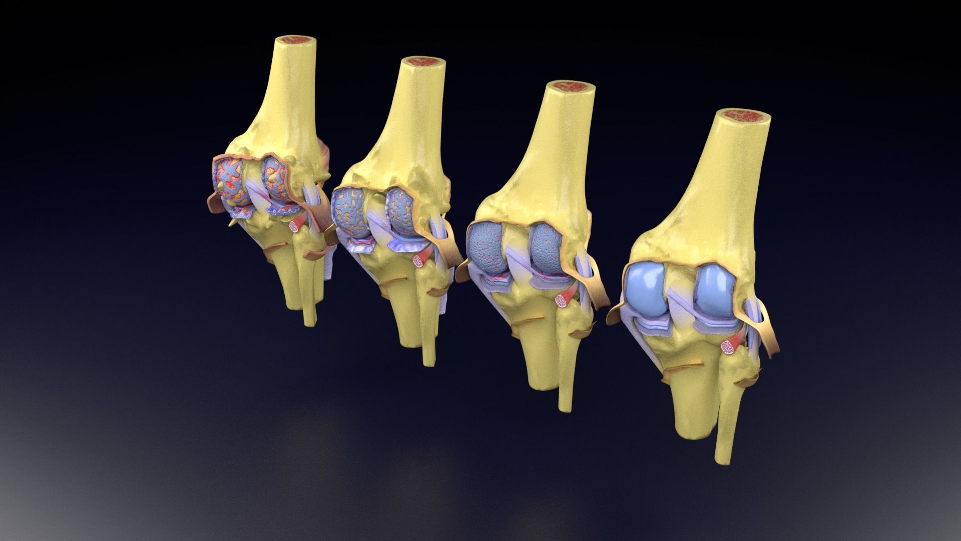 Osteoarthritis stages 3D model_50