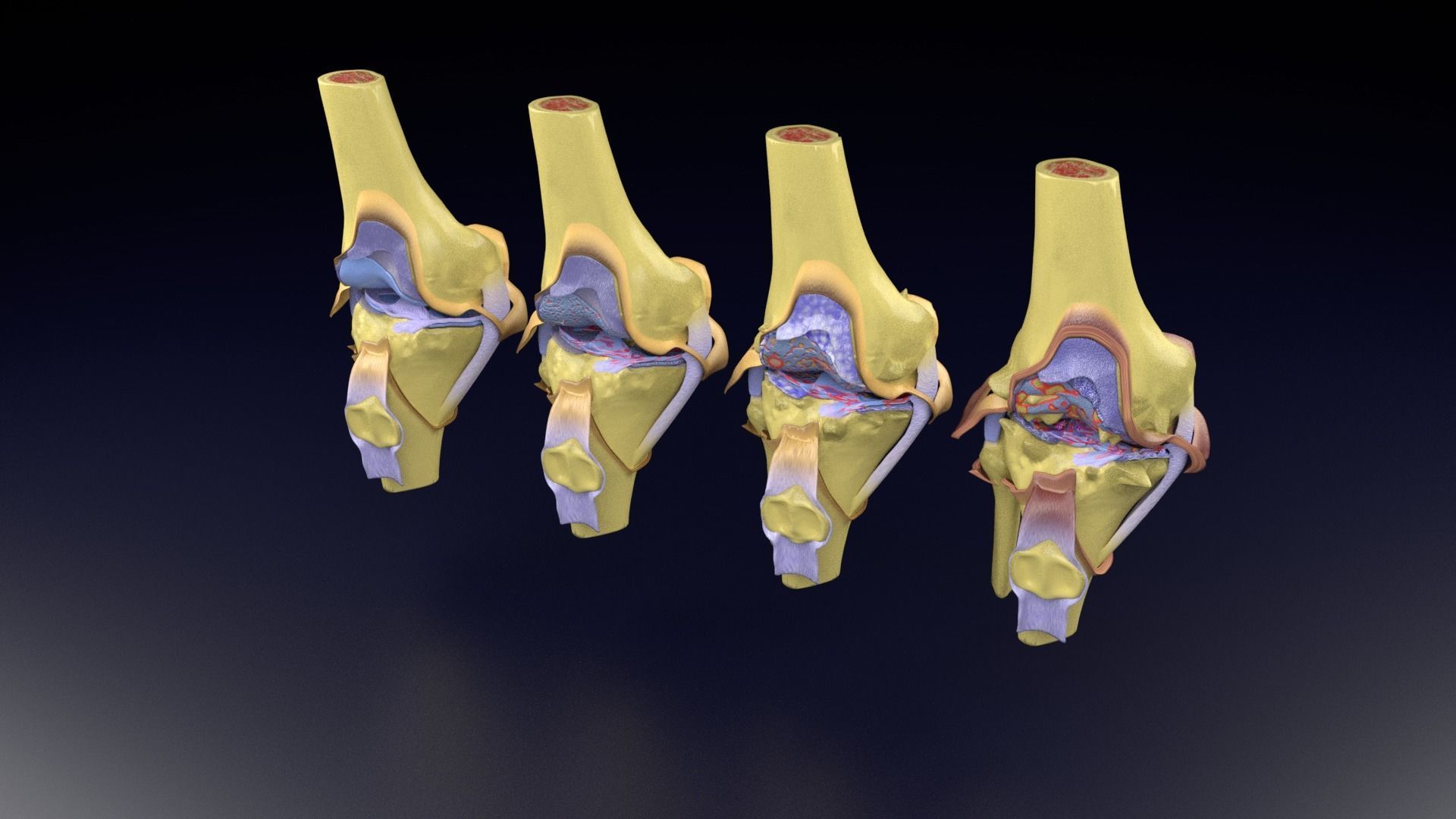 Osteoarthritis stages 3D model_89