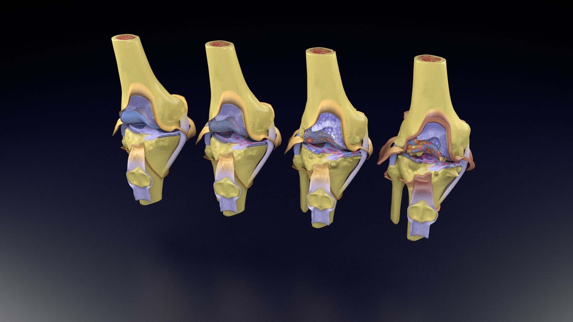Osteoarthritis stages 3D model_96
