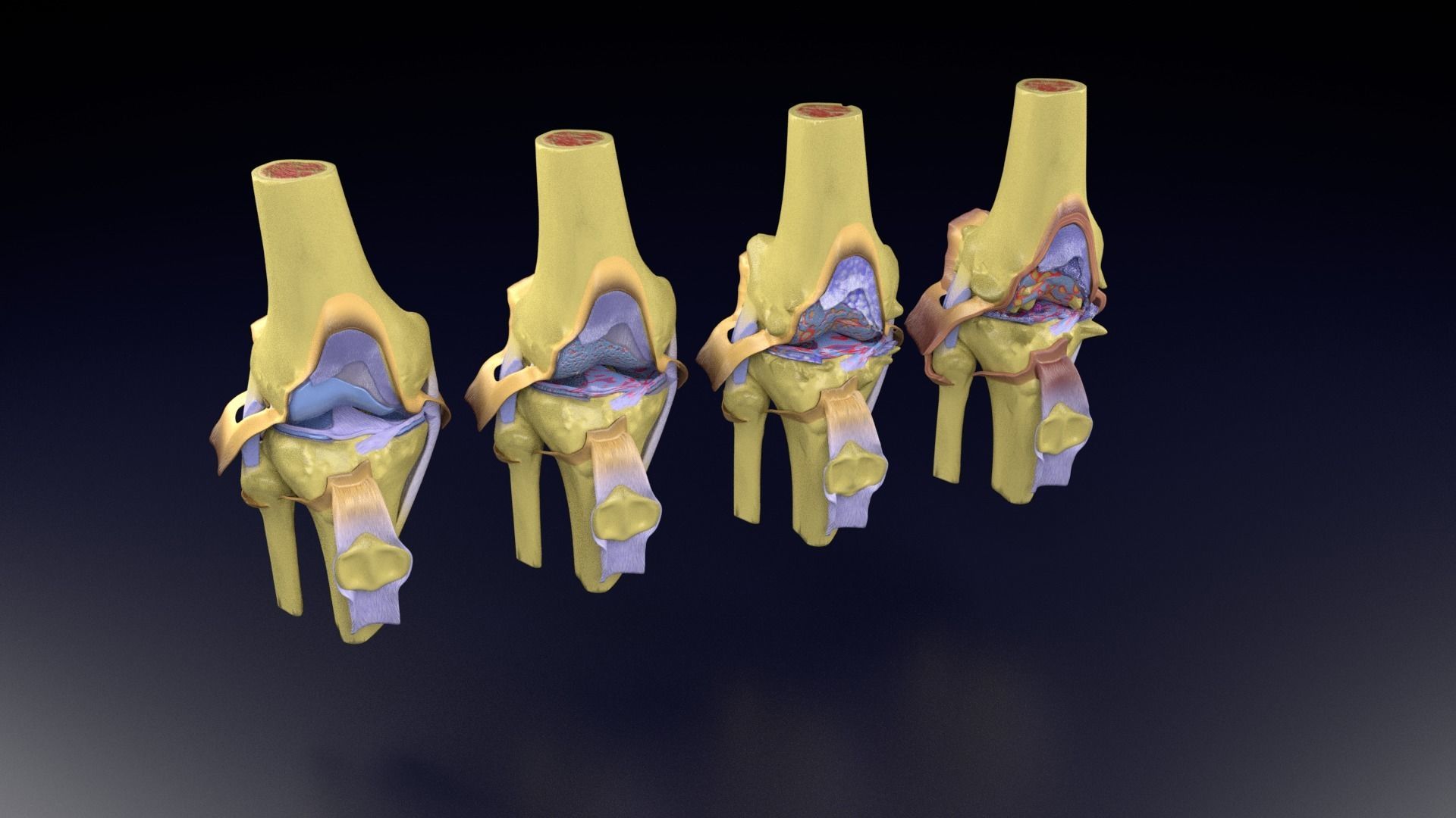 Osteoarthritis stages 3D model_103