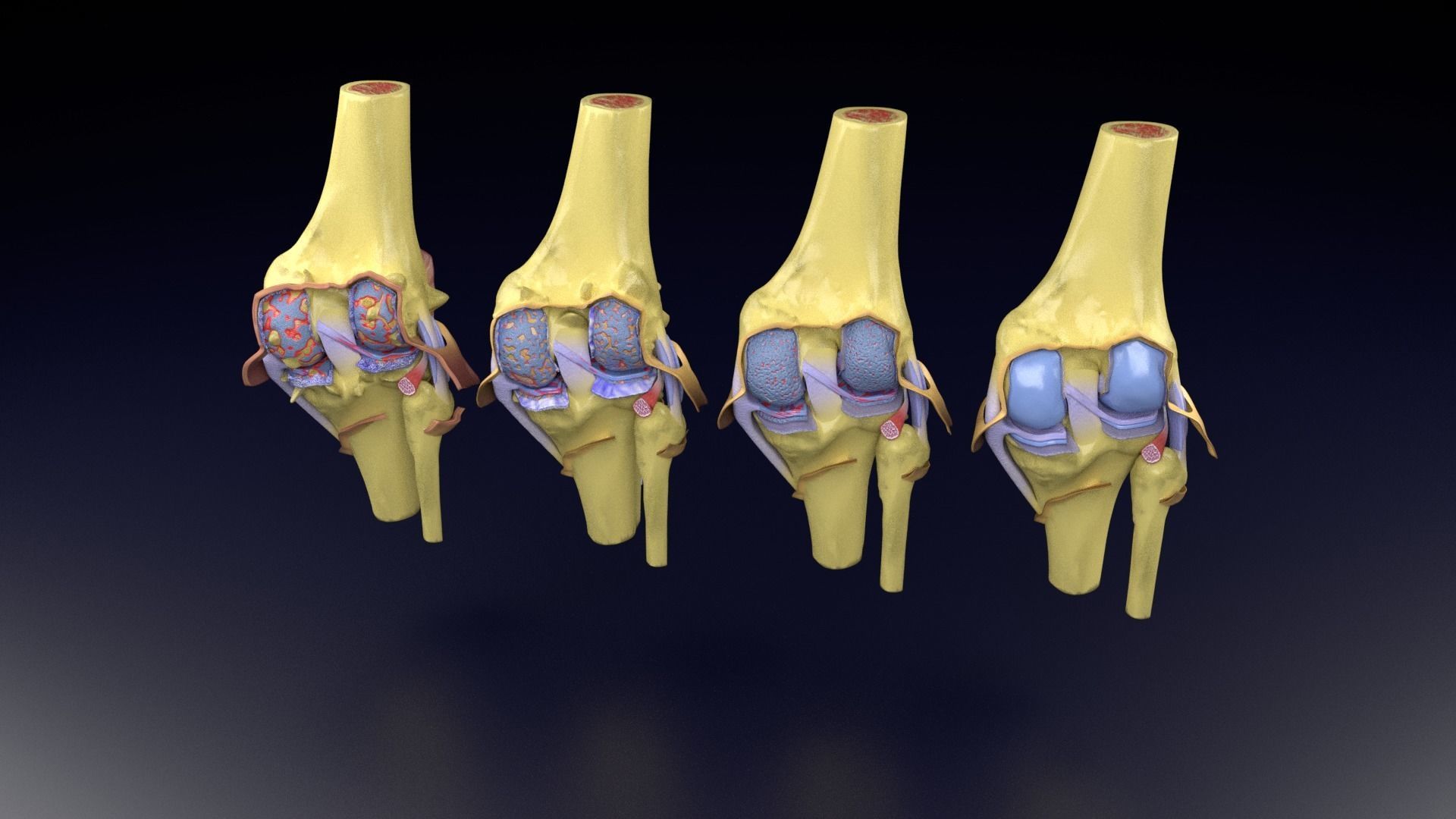Osteoarthritis stages 3D model_55