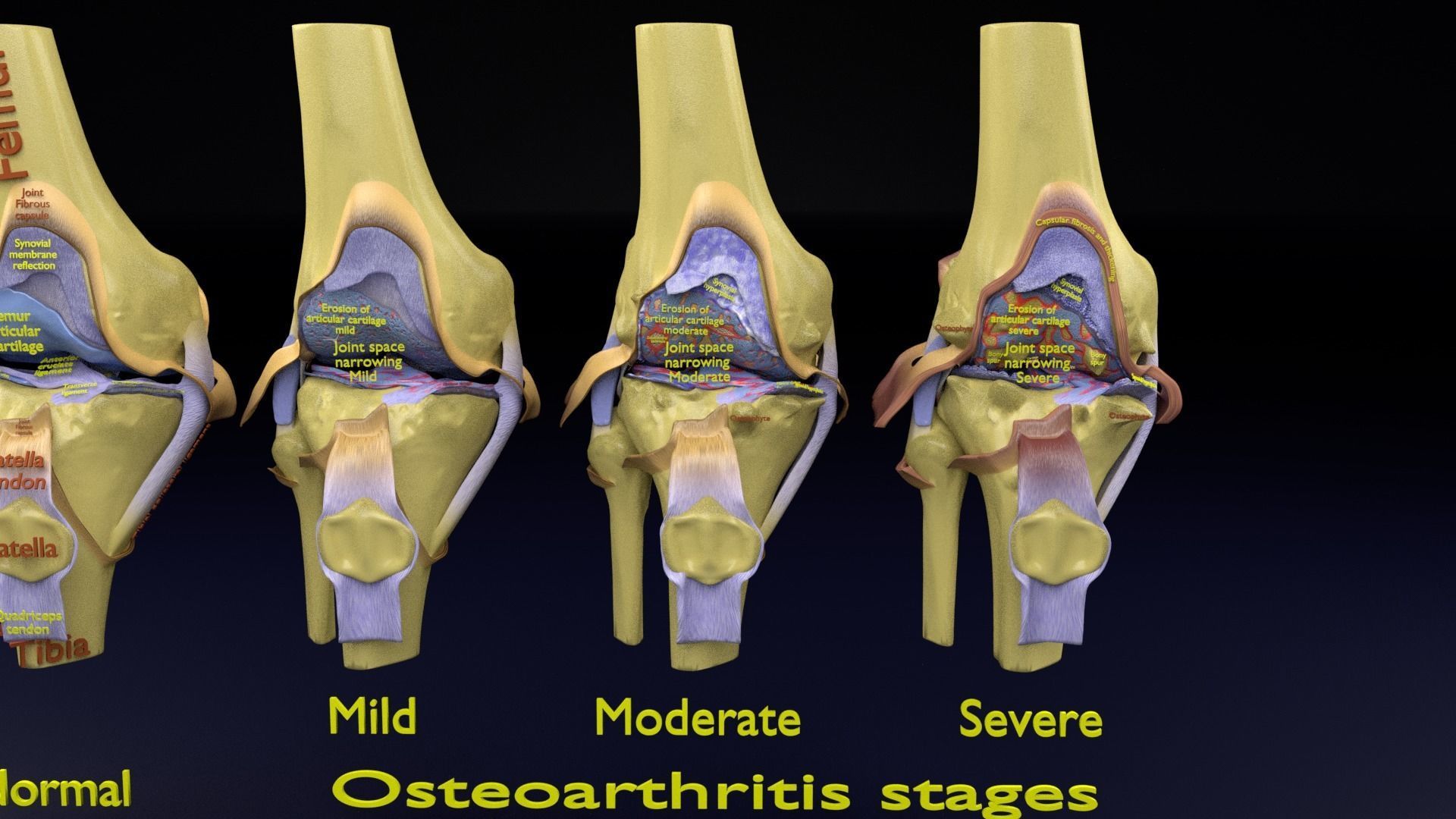Osteoarthritis stages 3D model_3