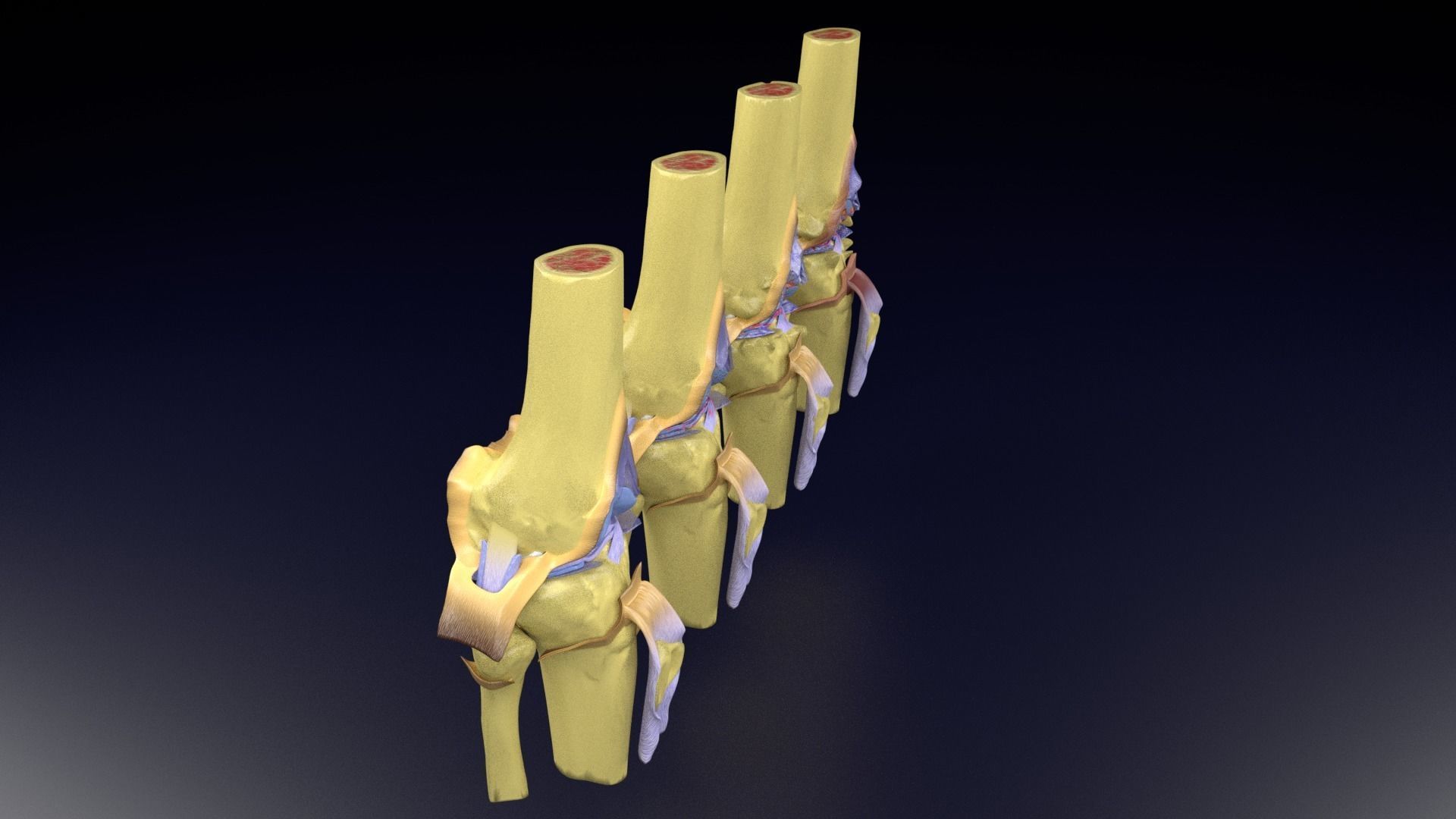 Osteoarthritis stages 3D model_38