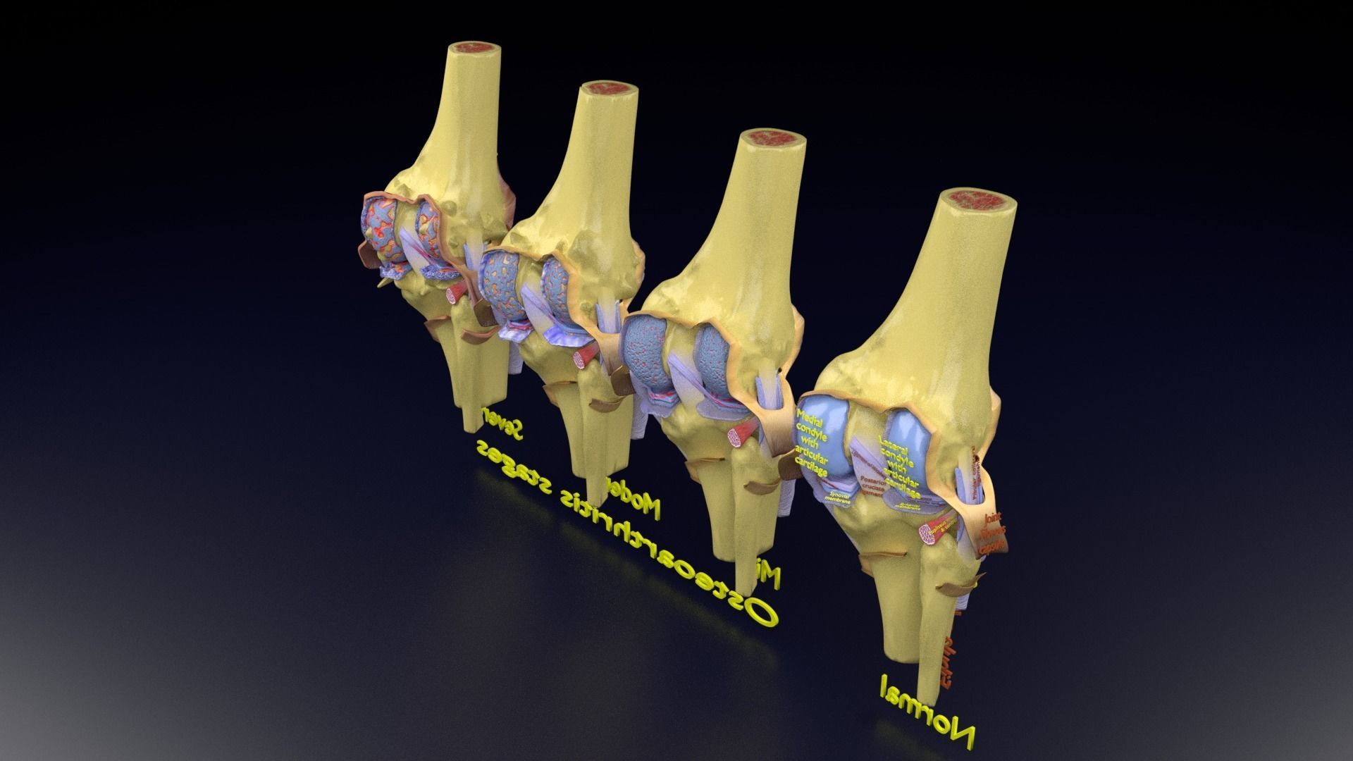 Osteoarthritis stages 3D model_130