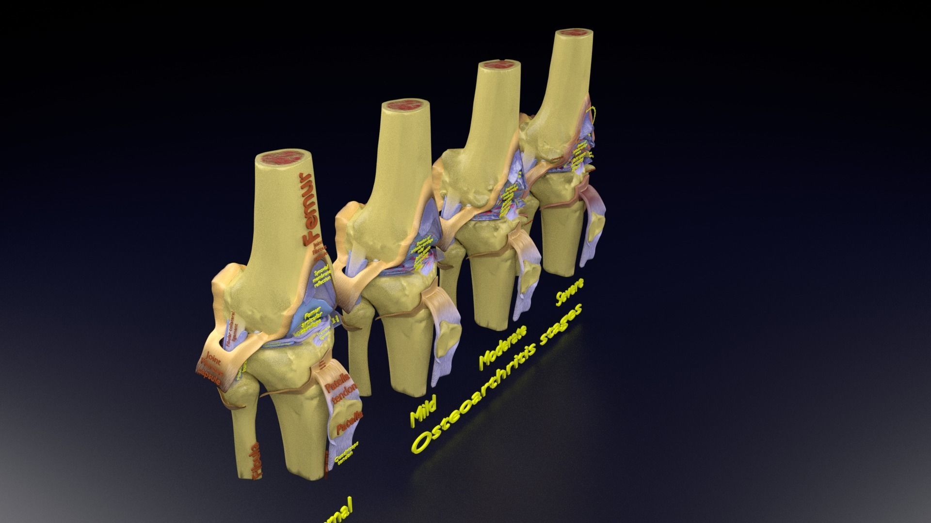 Osteoarthritis stages 3D model_117