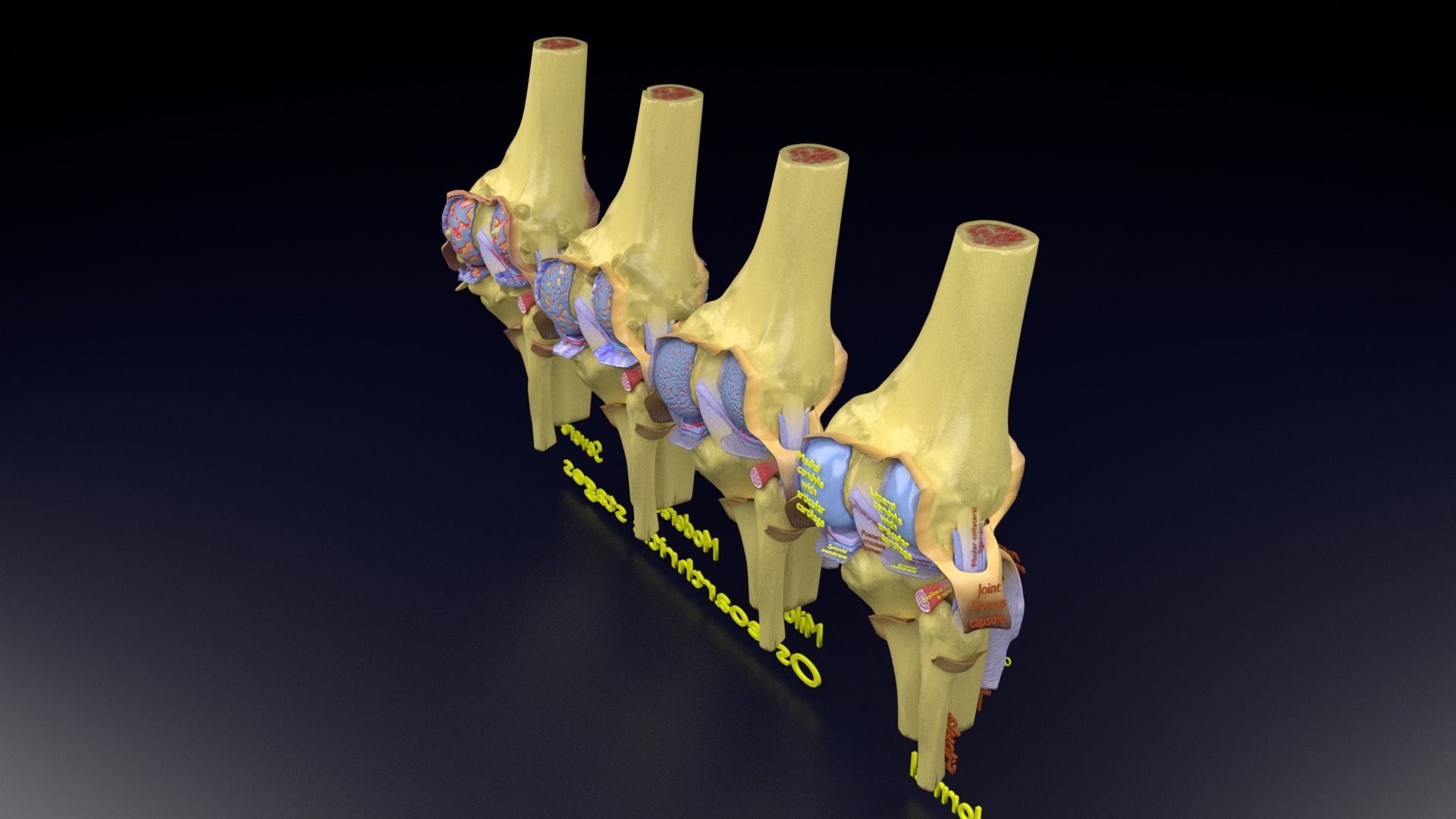 Osteoarthritis stages 3D model_129