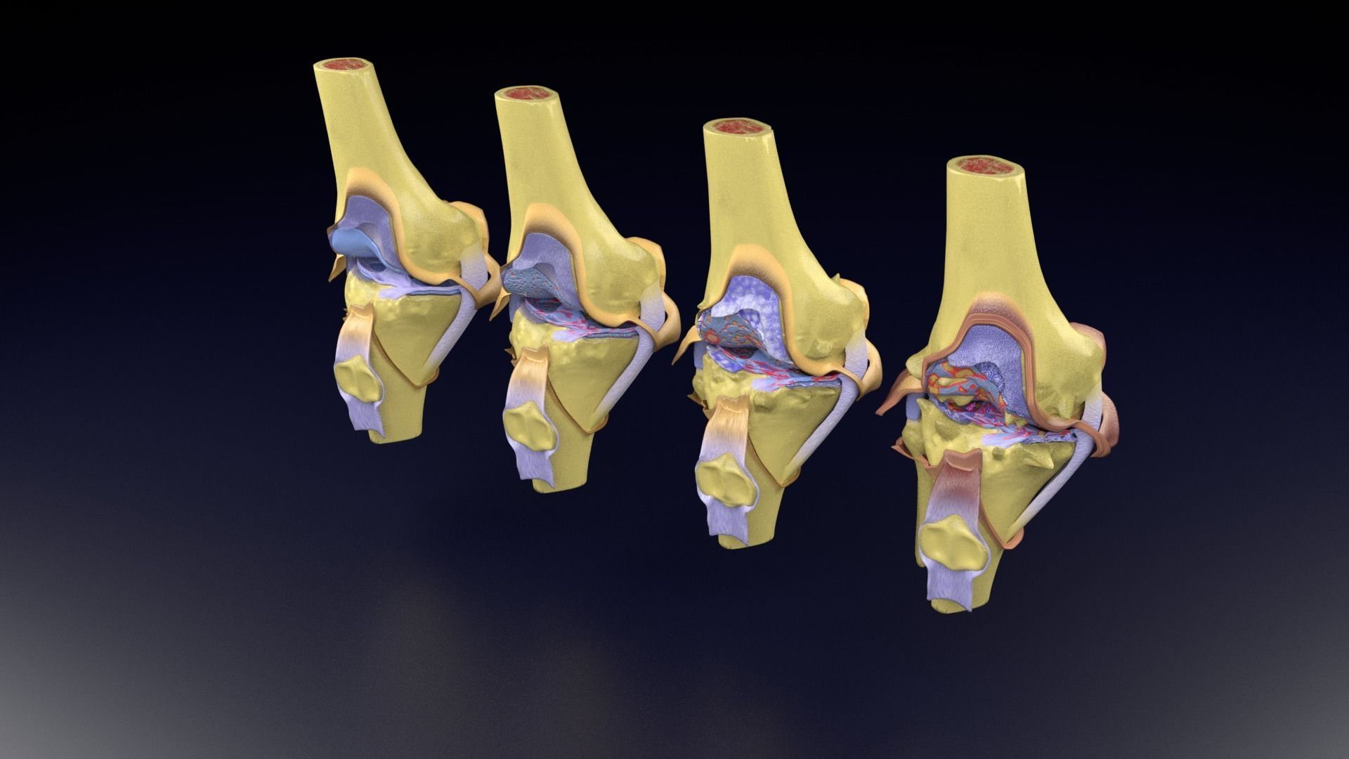 Osteoarthritis stages 3D model_88