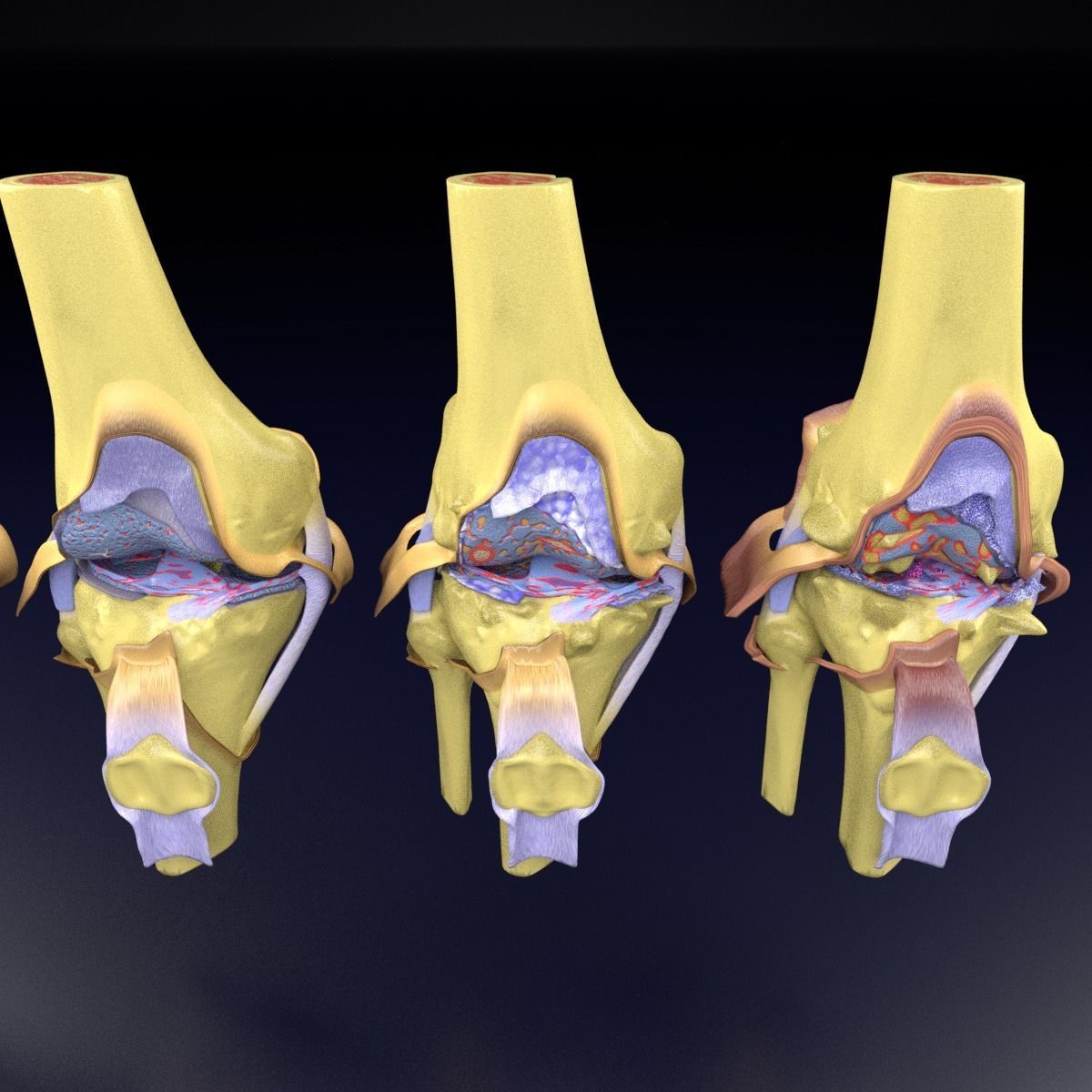 Osteoarthritis stages 3D model_32