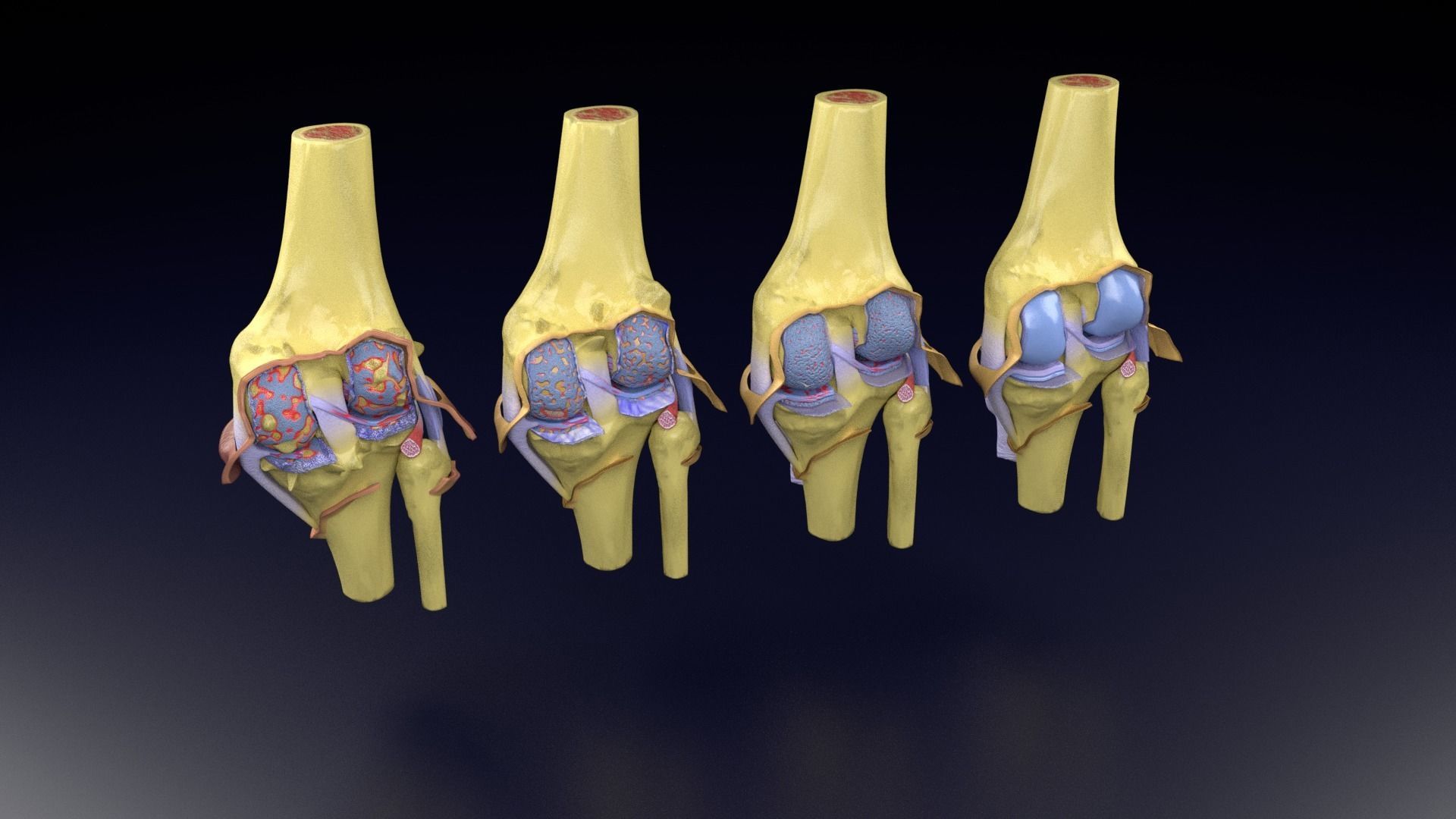 Osteoarthritis stages 3D model_59