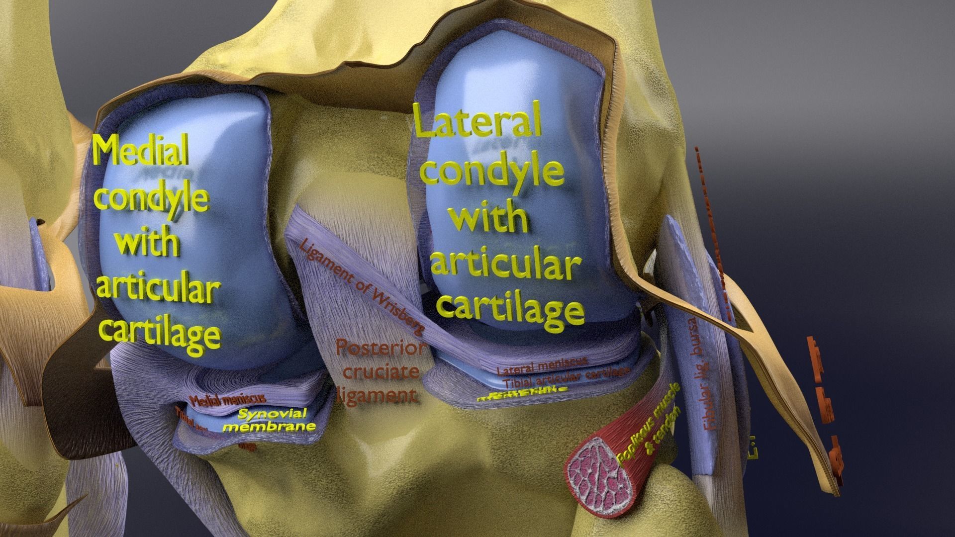 Osteoarthritis stages 3D model_21