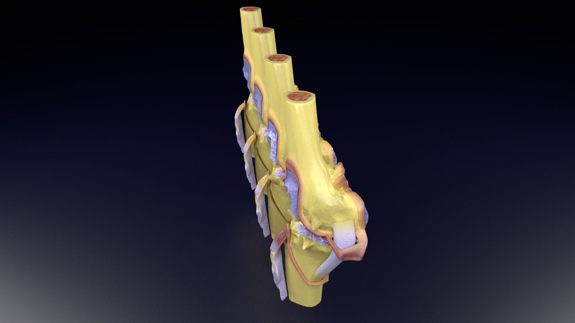 Osteoarthritis stages 3D model_75