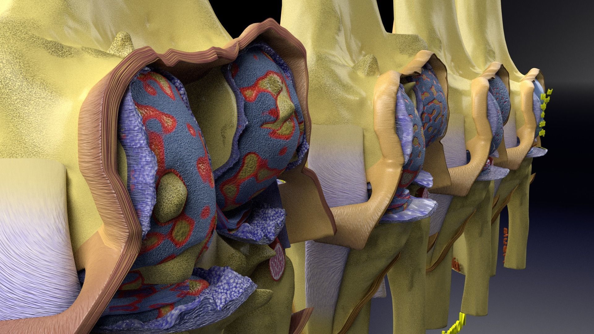 Osteoarthritis stages 3D model_17