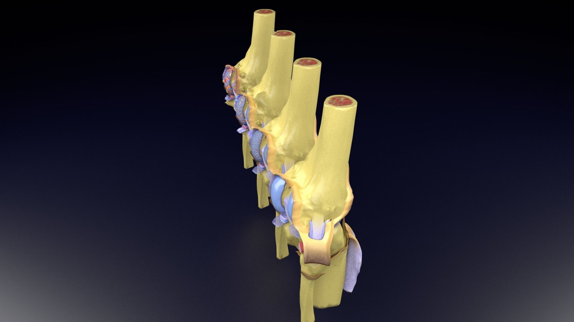 Osteoarthritis stages 3D model_42