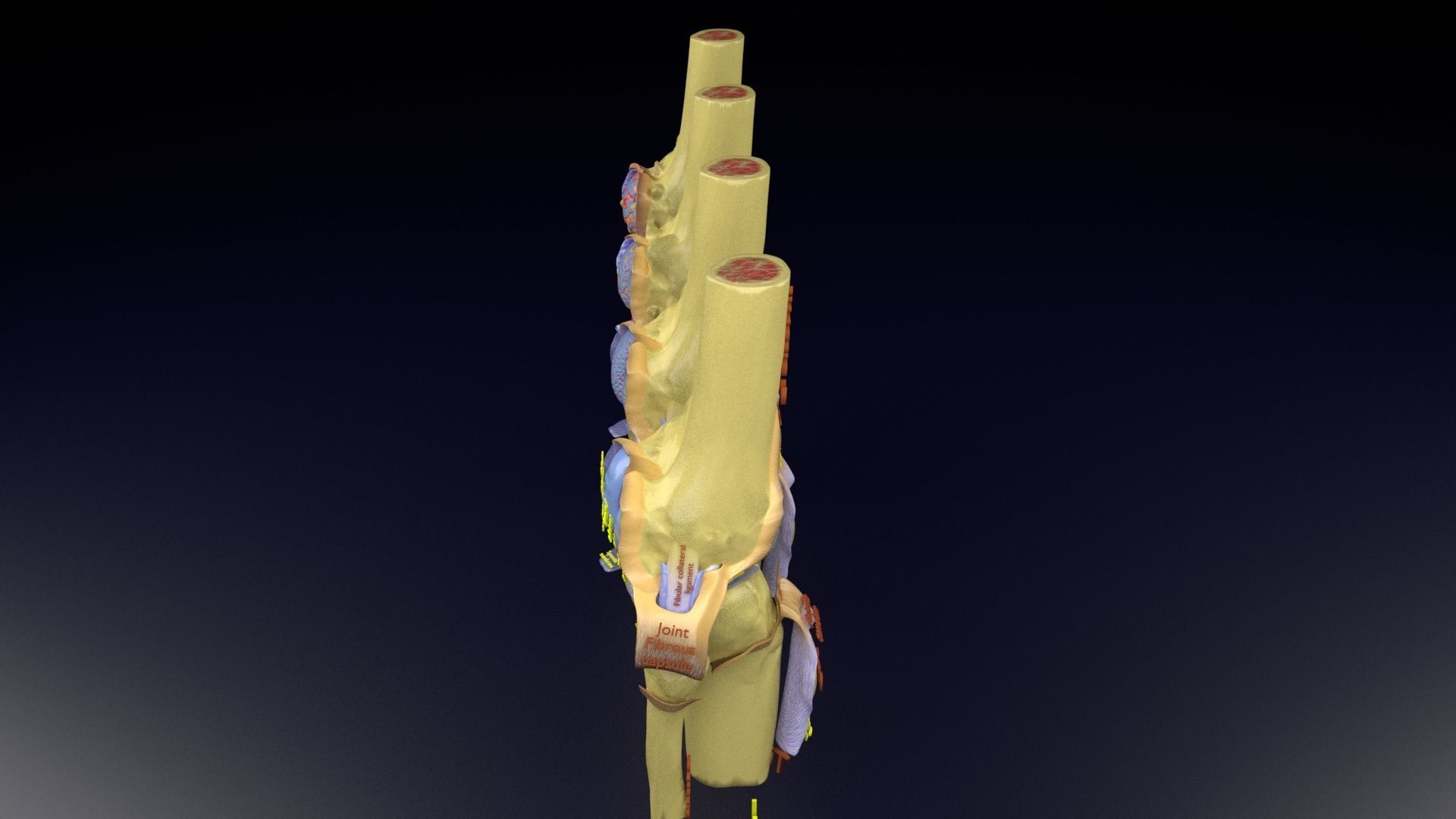 Osteoarthritis stages 3D model_124