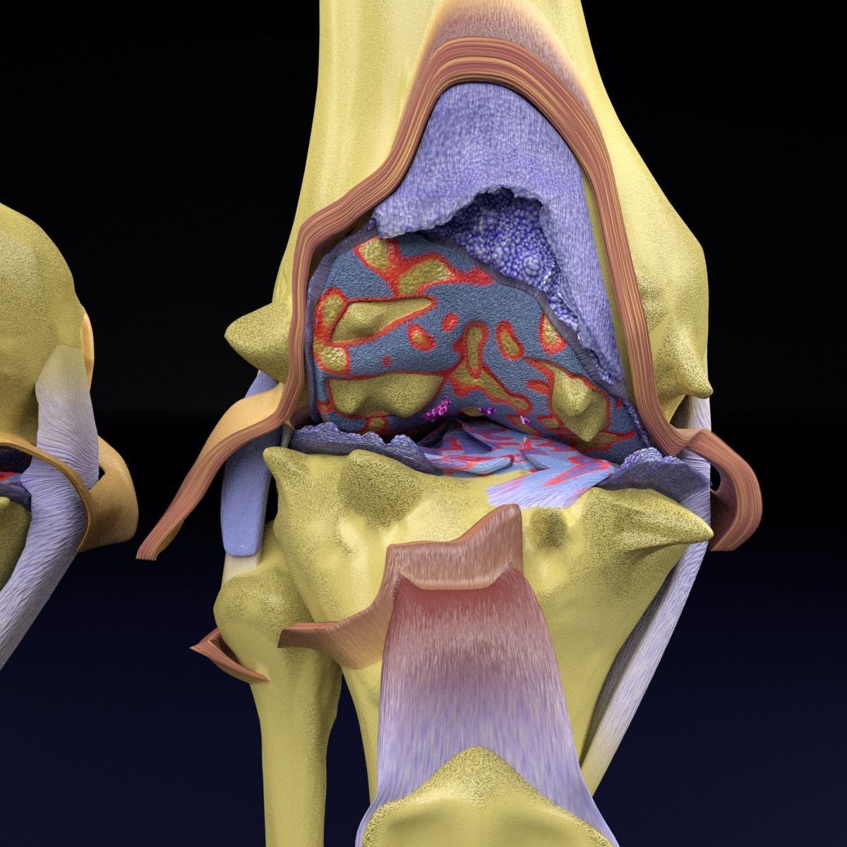 Osteoarthritis stages 3D model_13