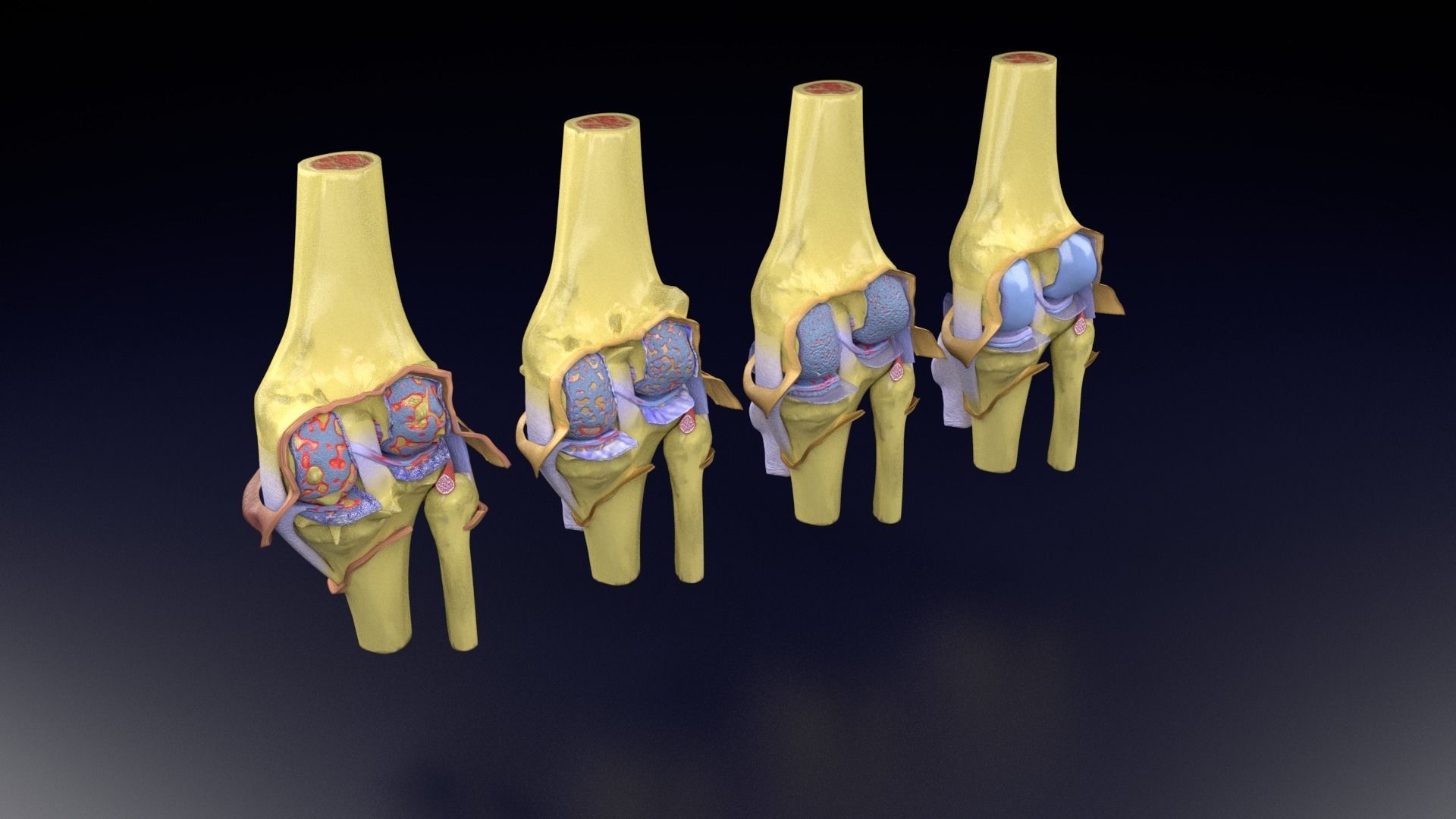 Osteoarthritis stages 3D model_61