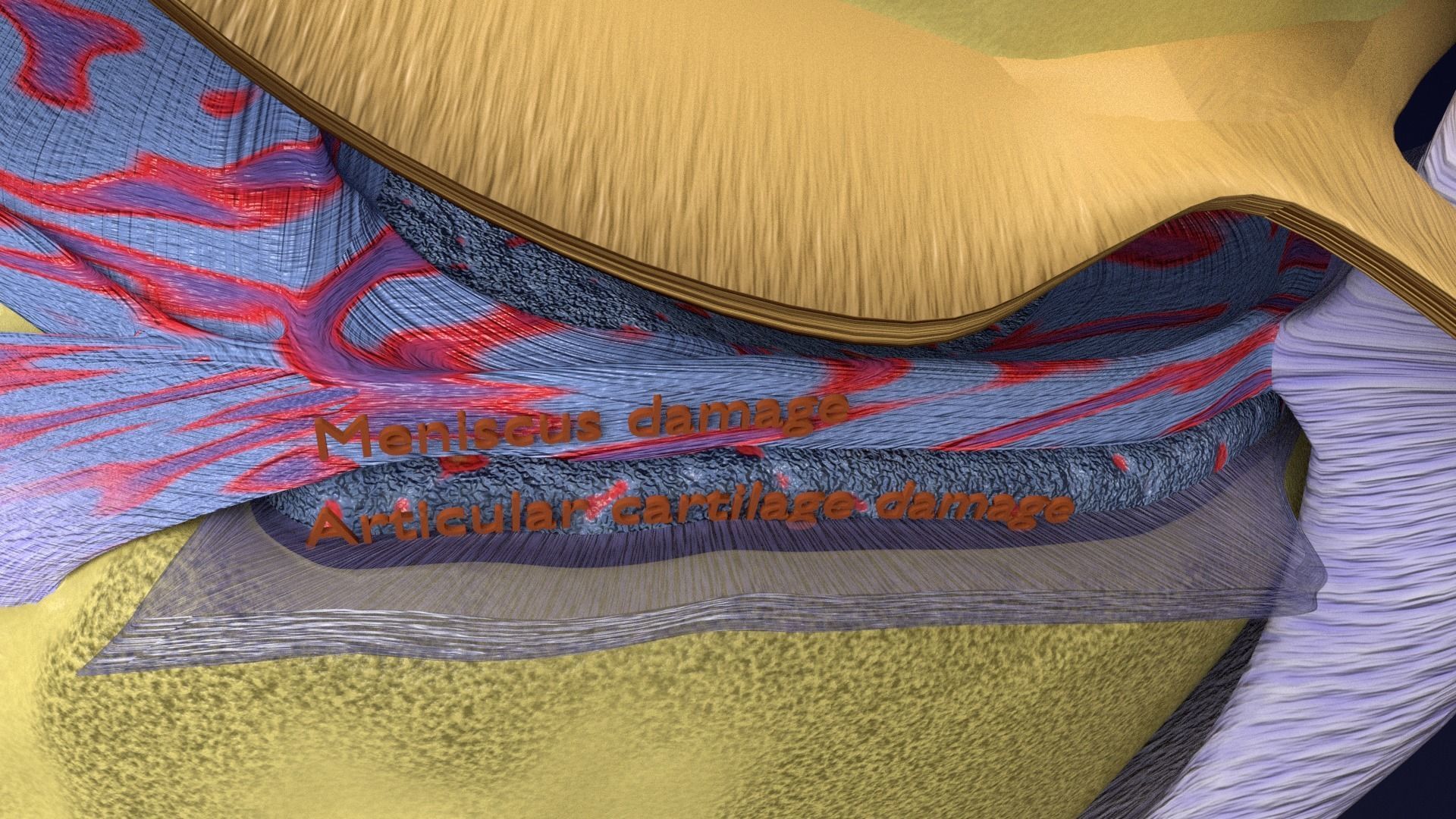 Osteoarthritis stages 3D model_29