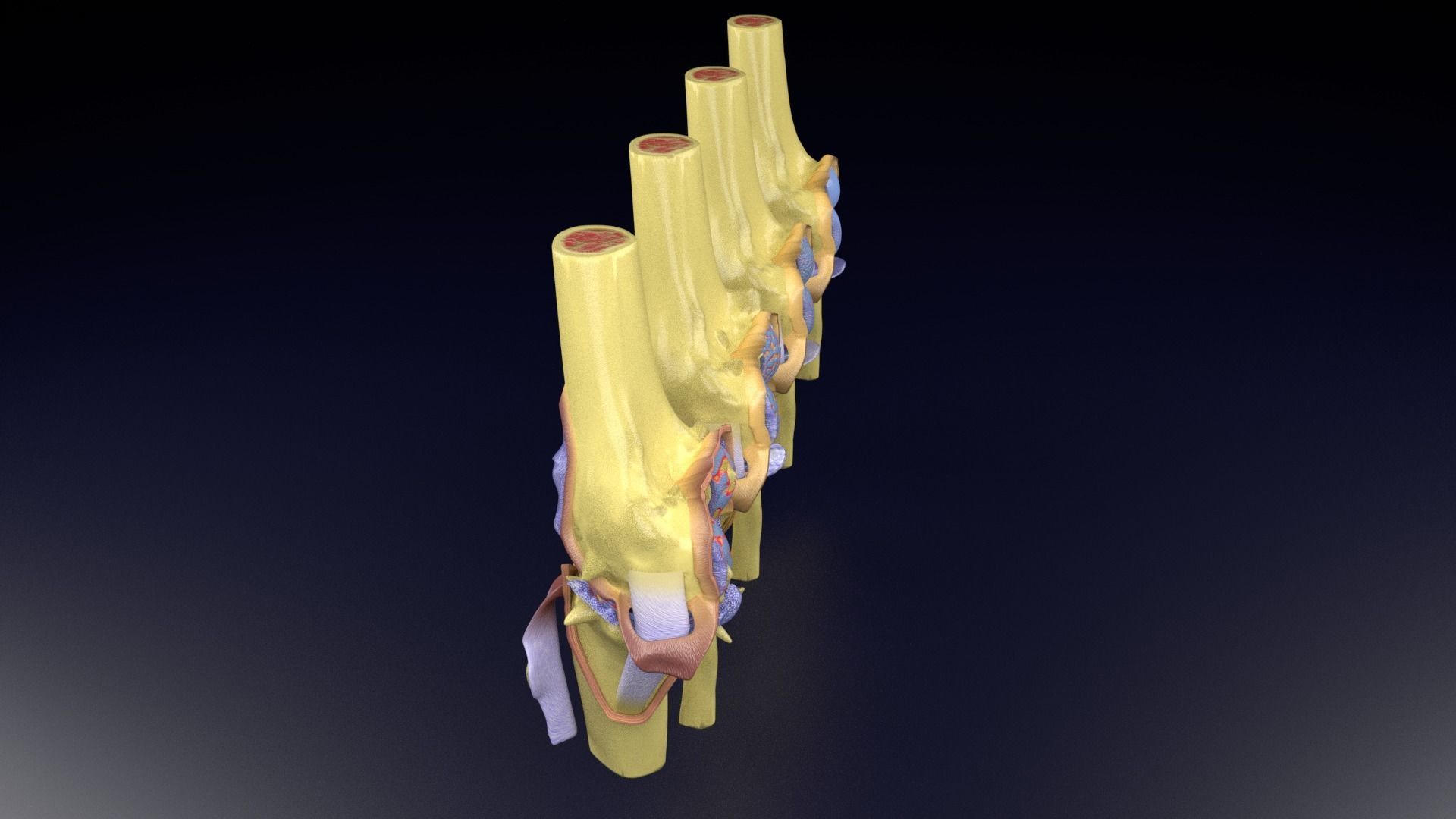 Osteoarthritis stages 3D model_71
