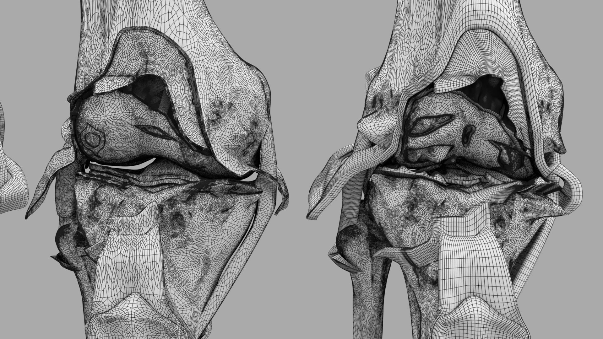 Osteoarthritis stages 3D model_34