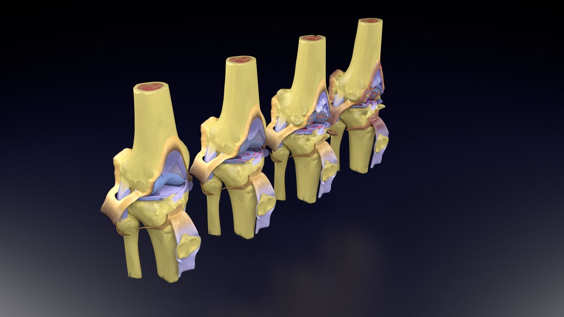 Osteoarthritis stages 3D model_105