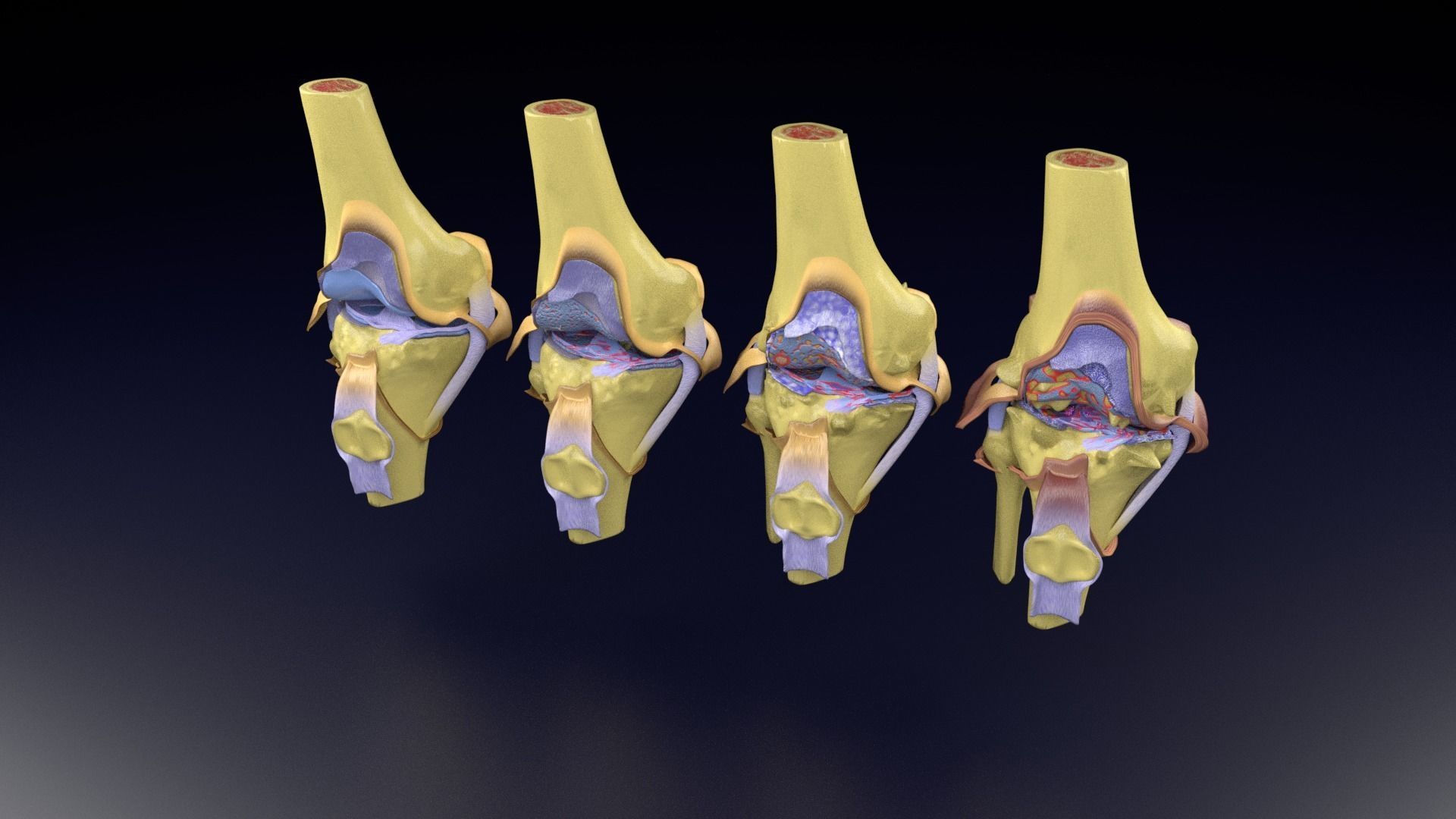 Osteoarthritis stages 3D model_98